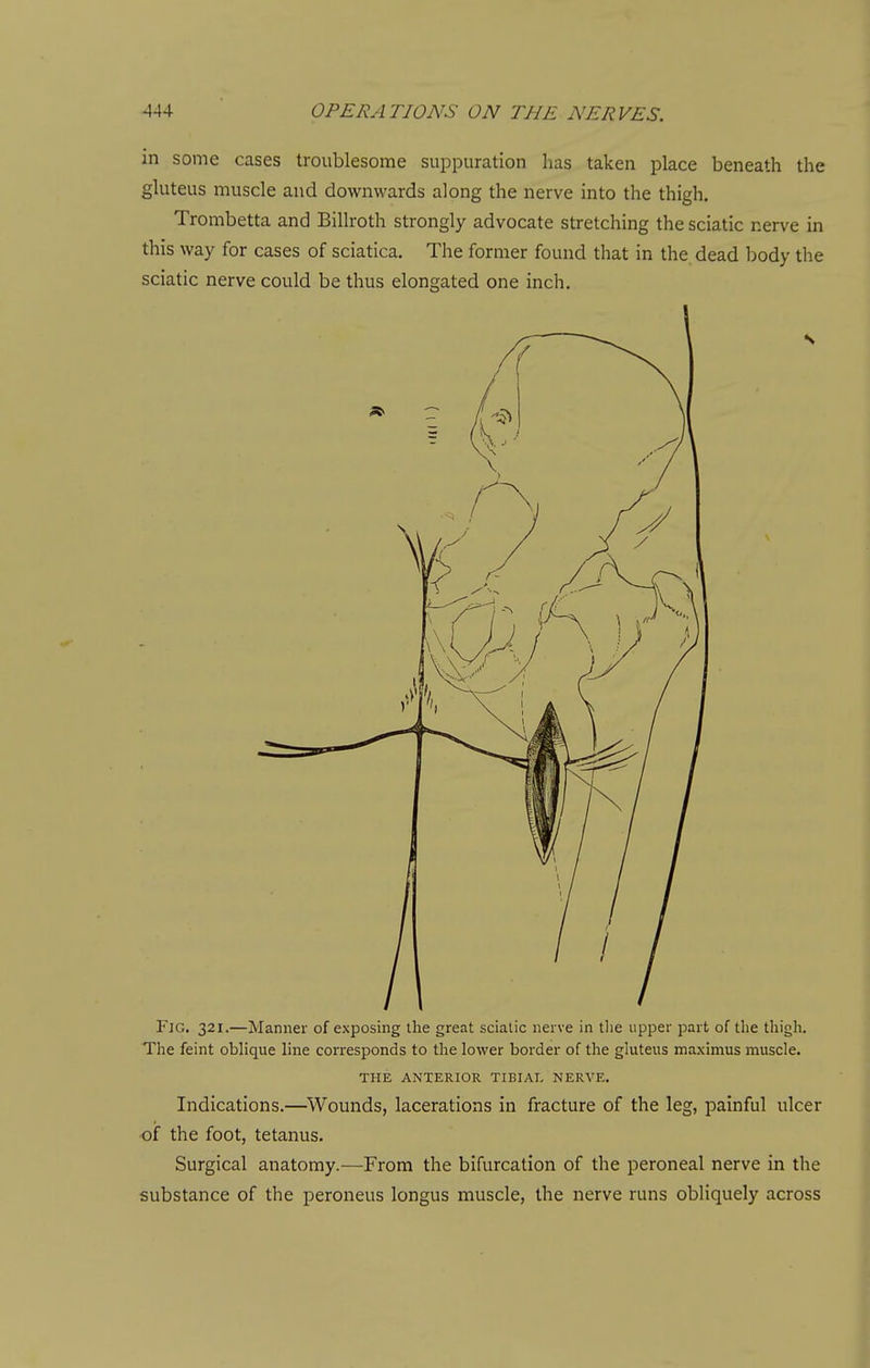 in some cases troublesome suppuration has taken place beneath the gluteus muscle and downwards along the nerve into the thigh. Trombetta and Billroth strongly advocate stretching the sciatic nerve in this way for cases of sciatica. The former found that in the dead body the sciatic nerve could be thus elongated one inch. Fig. 321.—Manner of exposing the great sciatic nerve in tlie upper part of the thigh. The feint oblique line corresponds to the lower border of the gluteus maximus muscle. THE ANTERIOR TIBIAL NERVE. Indications.—^Wounds, lacerations in fracture of the leg, painful ulcer •of the foot, tetanus. Surgical anatomy.—From the bifurcation of the peroneal nerve in the substance of the peroneus longus muscle, the nerve runs obliquely across