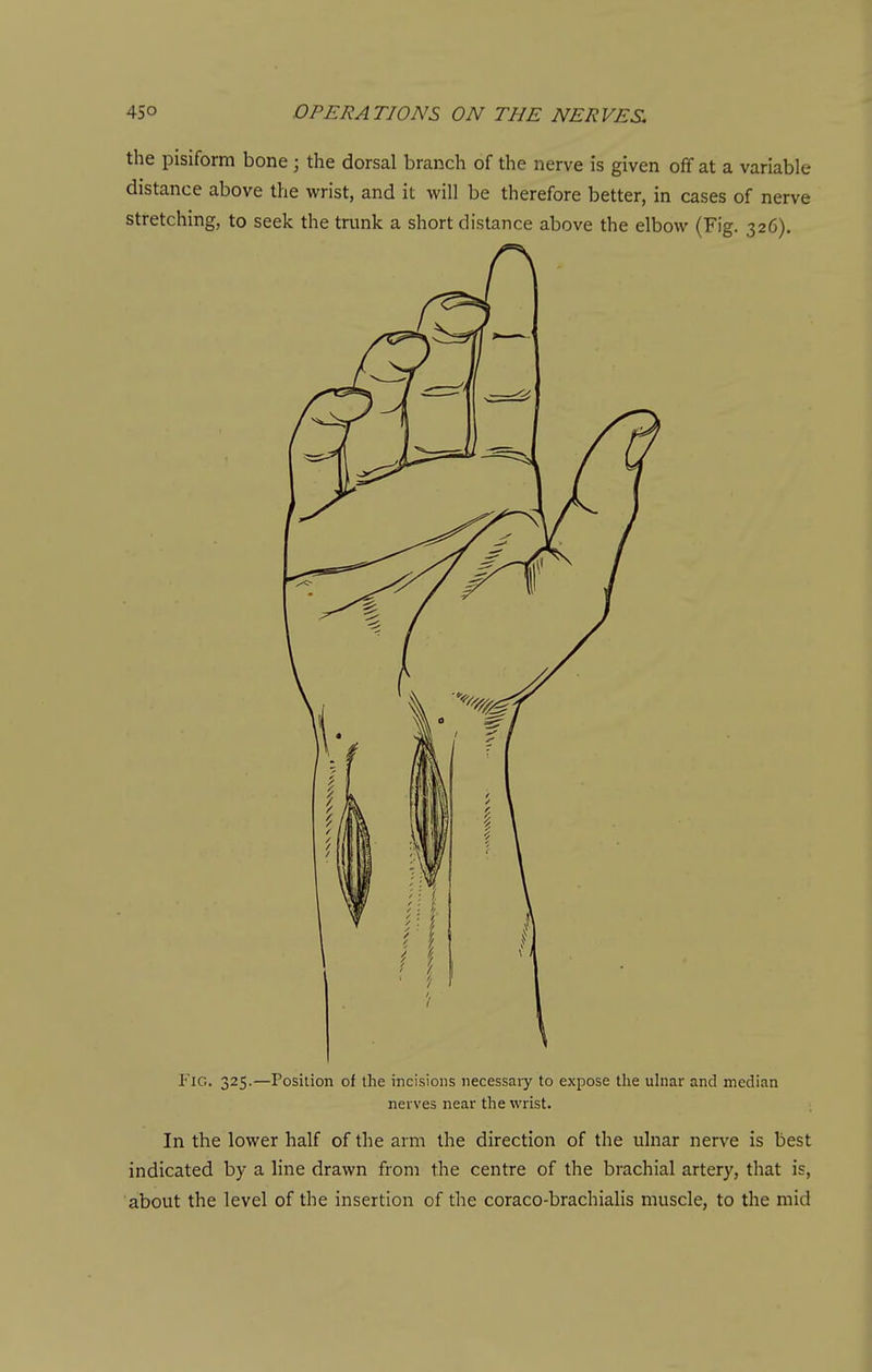 the pisiform bone; the dorsal branch of the nerve is given off at a variable distance above the wrist, and it will be therefore better, in cases of nerve stretching, to seek the trunk a short distance above the elbow (Fig. 326). Fig. 325.—Position of the incisions necessaiy to expose the uhiar and median nerves near the wrist. In the lower half of the arm the direction of the ulnar nerve is best indicated by a line drawn from the centre of the brachial artery, that is, about the level of the insertion of the coraco-brachialis muscle, to the mid