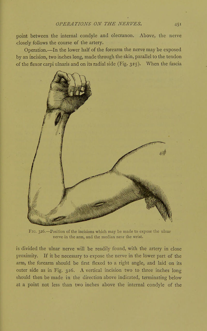 point between the internal condyle and olecranon. Above, the nerve closely follows the course of the artery. Operation.—In the lower half of the forearm the nerve may be exposed by an incision, two inches long, made through the skin, parallel to the tendon of the flexor carpi ulnaris and on its radial side (Fig. 325). When the fascia Fig. 326.—Position of the incisions which may be made to expose tlie ulnar nerve in the arm, and the median near the wrist. is divided the ulnar nerve will be readily found, with the artery in close proximity. If it be necessary to expose the nerve in the lower part of the arm, the forearm should be first flexed to a right angle, and laid on its outer side as in Fig. 326. A vertical incision two to three inches long should then be made in the direction above indicated, terminating below at a point not less than two inches above the internal condyle of the