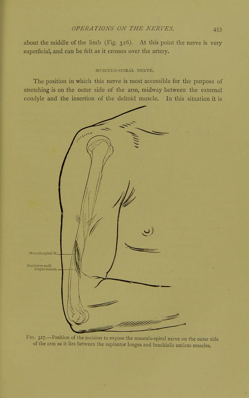 about the middle of the Hmb (Fig. 326). At this point the nerve is very superficial, and can be felt as it crosses over the artery. MUSCULO-SPIRAL NERVE. The position in which this nerve is most accessible for the purpose of stretching is on the outer side of the arm, midway between the external condyle aiid the insertion of the deltoid muscle. In this situation it is Musculo-spiral N. Supinator r,-icUi longus muscle. 1IG. 327.—I'osition of the incision to expose the musculo-spiral neive on the outer side of the arm as it lies between the supinator longus and brachialis amicus muscles.