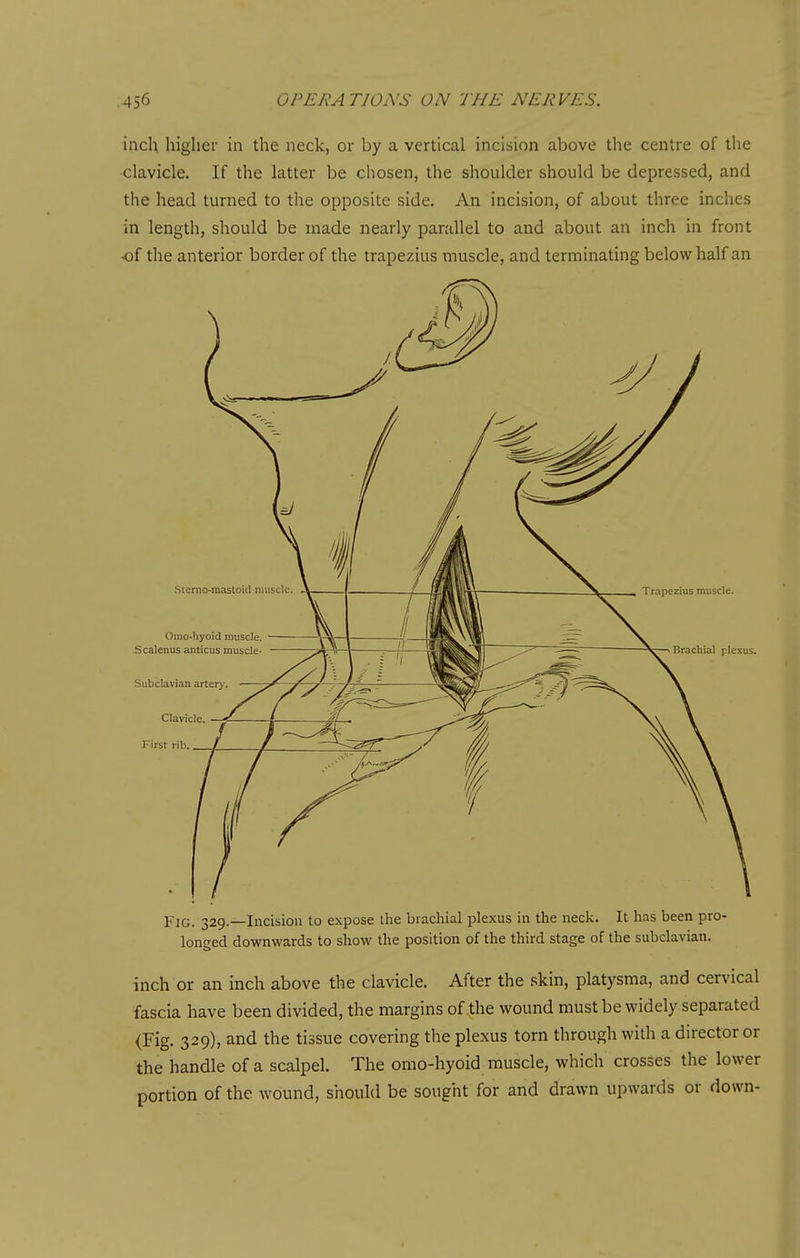 inch higher in the neck, or by a vertical incision above the centre of the clavicle. If the latter be chosen, the shoulder should be depressed, and the head turned to the opposite side. An incision, of about three inches in length, should be made nearly parallel to and about an inch in front •of the anterior border of the trapezius muscle, and terminating below half an Fig. 329.—Incision to expose llie brachial plexus in the neck. It has been pro- longed downwards to show the position of the third stage of the subclavian. inch or an inch above the clavicle. After the skin, platysma, and cervical fascia have been divided, the margins of the wound must be widely separated <Fig. 329), and the tissue covering the plexus torn through with a director or the handle of a scalpel. The omo-hyoid muscle, which crosses the lower portion of the wound, should be sought for and drawn upwards or down-