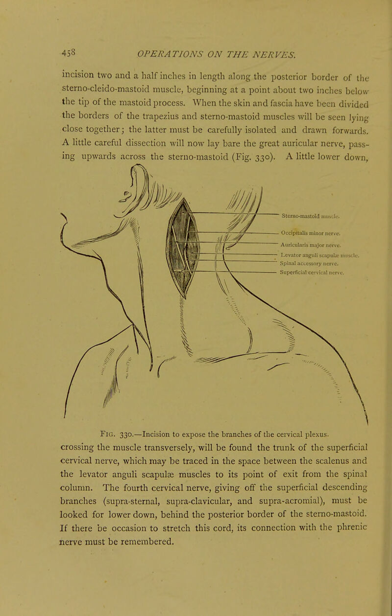 incision two and a half inches in length along the posterior border of the sterno-cleido-mastoid muscle, beginning at a point about two inches below the tip of the mastoid process. When the skin and fascia have been divided the borders of the trapezius and sterno-mastoid muscles will be seen lying close together; the latter must be carefully isolated and drawn forwards. A little careful dissection will now lay bare the great auricular nerve, pass- ing upwards across the sterno-mastoid (Fig. 330). A little lower down. Fig. 330.—Incision to expose the branches of the cervical plexus, crossing the muscle transversely, will be found the trunk of the superficial cervical nerve, which may be traced in the space between the scalenus and the levator anguli scapulae muscles to its point of exit from the spinal column. The fourth cervical nerve, giving off the superficial descending branches (supra-sternal, supra-clavicular, and supra-acromial), must be looked for lower down, behind the posterior border of the sterno-mastoid. If there be occasion to stretch this cord, its connection with the phrenic nerve must be remembered.