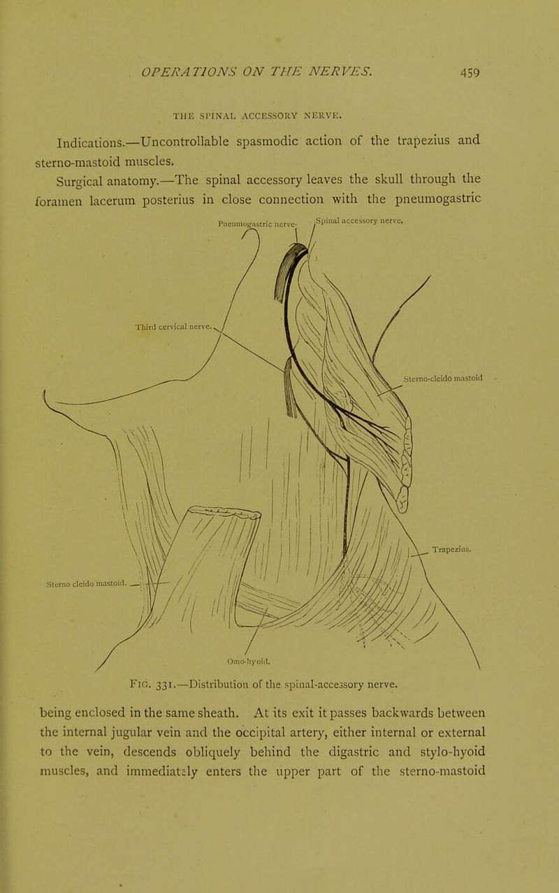THE SriNAL ACCESSORY NEUVK. Indications.—Uncontrollable spasmodic action of the trapezius and sterno-mastoid muscles. Surgical anatomy.—The spinal accessory leaves the skull through the foramen lacerum posterius in close connection with the pneumogastric Fig. 331.—Distribution of the spinal-acccosory nerve. being enclosed in the same sheath. At its exit it passes backwards between the internal jugular vein and the occipital artery, either internal or external to the vein, descends obliquely behind the digastric and stylo-hyoid muscles, and immediately enters the upper part of the sterno-mastoid