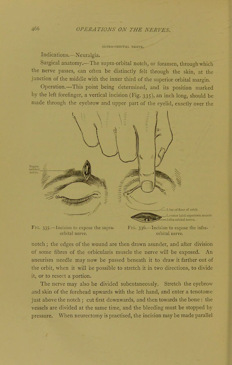 SUI'RA-OHIilTAL NKKVIi. Indications.—Neuralgia. Surgical anatomy.—The supra-orbital notch, or foramen, through which the nerve passes, can often be distinctly felt through the skin, at the junction of the middle with the inner third of the superior orbital margin. Operation.—This point being determined, and its position marked by the left forefinger, a vertical incision (Fig. 335), an inch long, should be made through the eyebrow and upper part of the eyelid, exactly over the Fig. 335.—Incision to expose the supra- Fig. 336.—Incision to expose the infra^ orbital nerve. orbital nerve. notch ; the edges of the wound are then drawn asunder, and after division of some fibres of the orbicularis muscle the nerve will be exposed. An aneurism needle may now be passed beneath it to draw it farther out of the orbit, when it will be possible to stretch it in two directions, to divide it, or to resect a portion. The nerve may also be divided subcutaneously. Stretch the eyebrow and skin of the forehead upwards with the left hand, and enter a tenotome just above the notch ; cut first downwards, and then towards the bone : the vessels are divided at the same time, and the bleeding must be stopped by pressure. When neurectomy is practised, the incision may be made parallel