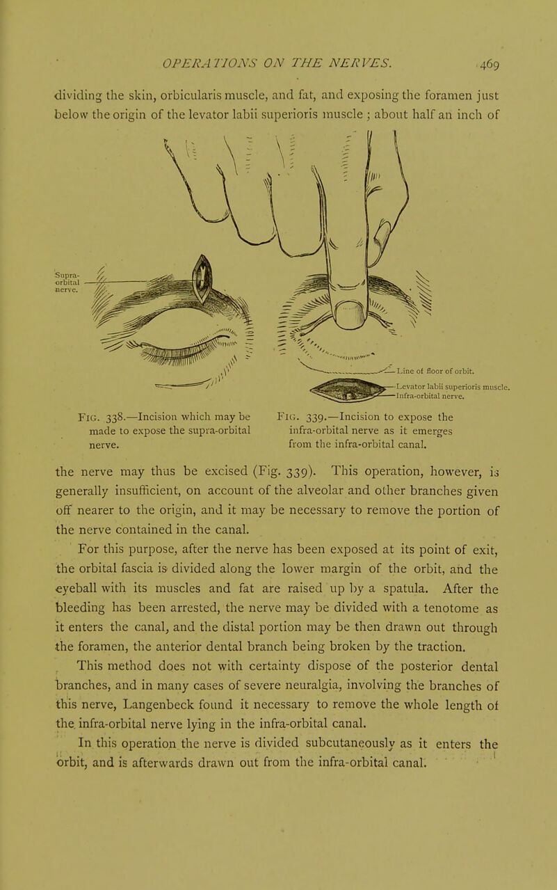 dividing the skin, orbicularis muscle, and fat, and exposing the foramen just below the origin of the levator labii superioris muscle ; about half an inch of Supra- orbital Fig. 338.—Incision wliich may be Fit;. 339,—Incision to expose the made to expose the supia-orbital infra-orbital nerve as it emei-ges nerve. from tlie infra-orbital canal. the nerve may thus be excised (Fig. 339). This operation, however, is generally insufficient, on account of the alveolar and other branches given off nearer to the origin, and it may be necessary to remove the portion of the nerve contained in the canal. For this purpose, after the nerve has been exposed at its point of exit, the orbital fascia is divided along the lower margin of the orbit, and the eyeball with its muscles and fat are raised up by a spatula. After the bleeding has been arrested, the nerve may be divided with a tenotome as it enters the canal, and the distal portion may be then drawn out through the foramen, the anterior dental branch being broken by the traction. This method does not with certainty dispose of the posterior dental branches, and in many cases of severe neuralgia, involving the branches of this nerve, Langenbeck found it necessary to remove the whole length of the. infra-orbital nerve lying in the infra-orbital canal. In this operation the nerve is divided subcutaneously as it enters the orbit, and is afterwards drawn out from the infra-orbital canal. '
