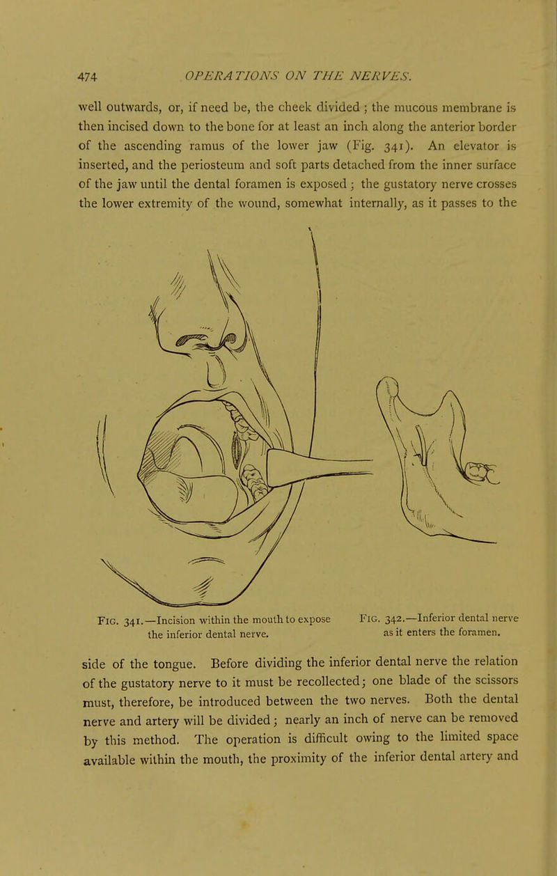 well outwards, or, if need be, the cheek divided ; the mucous membrane is then incised down to the bone for at least an inch along the anterior border of the ascending ramus of the lower jaw (Fig. 341). An elevator is inserted, and the periosteum and soft parts detached from the inner surface of the jaw until the dental foramen is exposed ; the gustatory nerve crosses the lower extremity of the wound, somewhat internally, as it passes to the Fig. 341.—Incision within the mouth to expose FlG. 342.—Inferior dental nerve the inferior dental nerve. as it enters the foramen. side of the tongue. Before dividing the inferior dental nerve the relation of the gustatory nerve to it must be recollected; one blade of the scissors must, therefore, be introduced between the two nerves. Both the dental nerve and artery will be divided; nearly an inch of nerve can be removed by this method. The operation is difficult owing to the limited space available within the mouth, the proximity of the inferior dental artery and