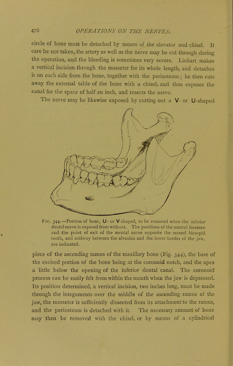 circle of bone must be detached by means of the elevator and chisel. It care be not taken, the artery as well as the nerve may be cut through during the operation, and the bleeding is sometimes very severe. Linhart makes a vertical incision through the masseter for its whole length, and detaches it on each side from the bone, together with the periosteum ; he then cuts away the external table of the bone with a chisel, and thus exposes the canal for the space of half an inch, and resects the nerve. The nerve may be likewise exposed by cutting out a V- or U-shaped Fig. 344.—Portion of bone, U- or V-shaped, to be removed when the inferior dental nerve is exposed from without. The positions of the mental foramen and the point of exit of the mental nerve opposite the second bicuspid tooth, and midway between the alveolus and the lower border of the jaw, are indicated. piece of the ascending ramus of the maxillary bone (Fig. 344), the base of the excised portion of the bone being at the coronoid notch, and the apex a little below the opening of the inferior dental canal. The coronoid process can be easily felt from within the mouth when the jaw is depressed. Its position determined, a vertical incision, two inches long, must be made through the integuments over the middle of the ascending ramus of the jaw, the masseter is sufficiendy dissected from its attachment to the ramus, and the periosteum is detached Avith it. The necessary amount of bone may then be removed with the chisel, or by means of a cylindrical