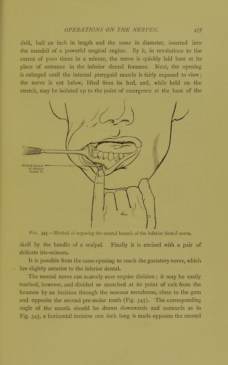 drill, half an inch in length and the same in diameter, inserted into the mandril of a powerful surgical engine. By it, in revolutions to the extent of 5000 times in a minute, the nerve is quickly laid bare at its place of entrance in the inferior dental foramen. Next, the opening is enlarged until the internal pterygoid muscle is fairly exposed to view; the nerve is cut below, lifted from its bed, and, while held on the stretch, may be isolated up to the point of emergence at the base of the Fig. 345.—Method of exposing the mental branch of the inferior dental nerve. skull by the handle of a scalpel. Finally it is excised with a pair of delicate iris-scissors. It is possible from the same opening to reach the gustatory nerve, which lies slightly anterior to the inferior dental. The mental nerve can scarcely ever require division ; it may be easily reached, however, and divided or stretched at its point of exit from the foramen by an incision through the mucous membrane, close to the gum and opposite the second pre-molar tooth (Fig. 345). The corresponding angle of the mouth should be drawn downwards and outwards as in F'g- 345> 2, horizontal incision one inch long is made opposite the second