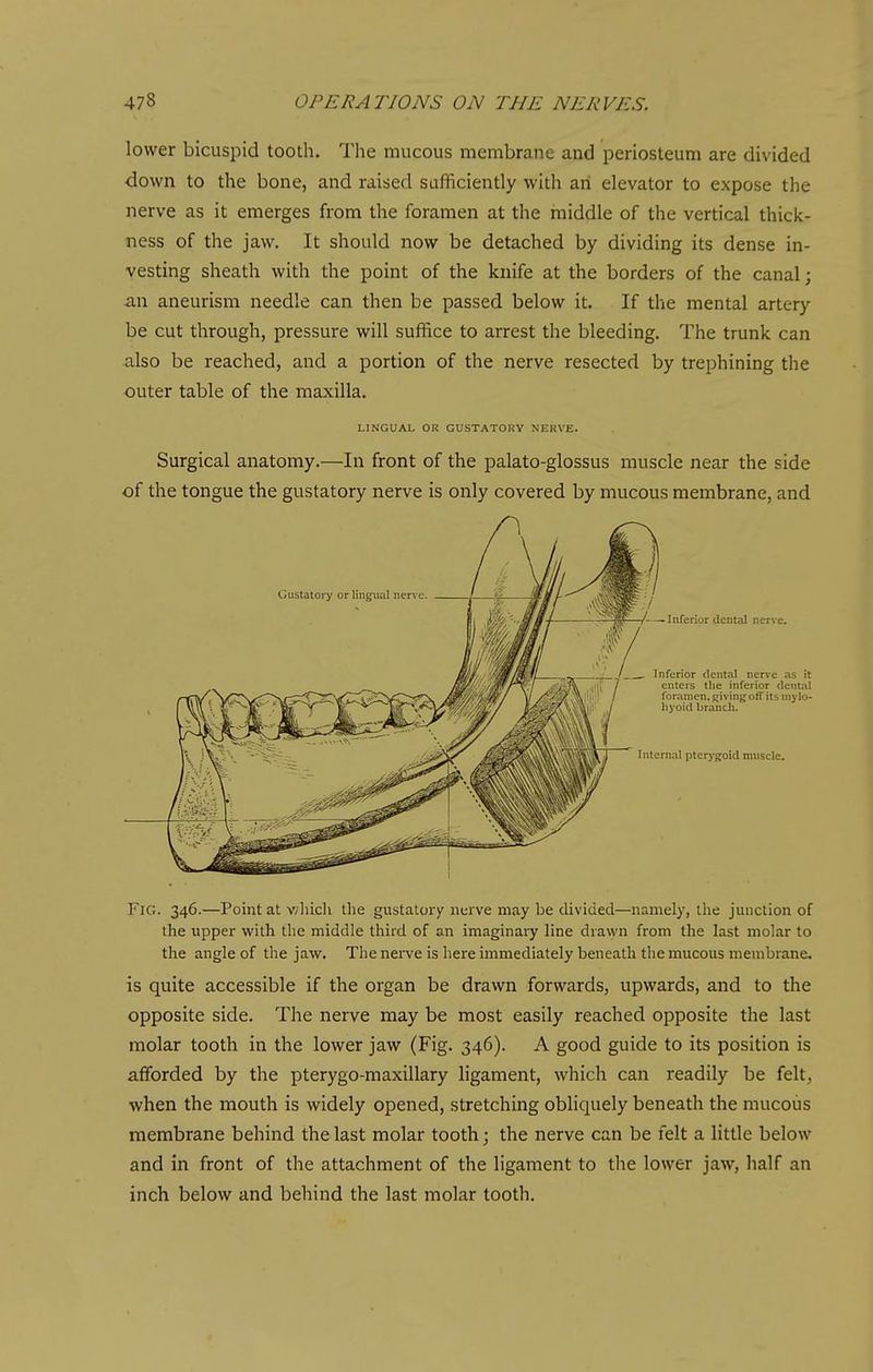 lower bicuspid tooth. The mucous membrane and periosteum are divided down to the bone, and raised sufficiently with an elevator to expose the nerve as it emerges from the foramen at the middle of the vertical thick- ness of the jaw. It should now be detached by dividing its dense in- vesting sheath with the point of the knife at the borders of the canal; an aneurism needle can then be passed below it. If the mental artery be cut through, pressure will suffice to arrest the bleeding. The trunk can also be reached, and a portion of the nerve resected by trephining the outer table of the maxilla. LINGUAL OR GUSTATORY NERVE. Surgical anatomy.—In front of the palato-glossus muscle near the side of the tongue the gustatory nerve is only covered by mucous membrane, and Fig. 346.—Point at v/hich the gustatory nerve may be divided—namely, the junction of the upper with the middle third of an imaginary line drawn from the last molar to the angle of the jaw. The nei-ve is here immediately beneath the mucous membrane. is quite accessible if the organ be drawn forwards, upwards, and to the opposite side. The nerve may be most easily reached opposite the last molar tooth in the lower jaw (Fig. 346). A good guide to its position is afforded by the pterygo-maxillary ligament, which can readily be felt, when the mouth is widely opened, stretching obliquely beneath the mucous membrane behind the last molar tooth; the nerve can be felt a little below and in front of the attachment of the ligament to the lower jaw, half an inch below and behind the last molar tooth.
