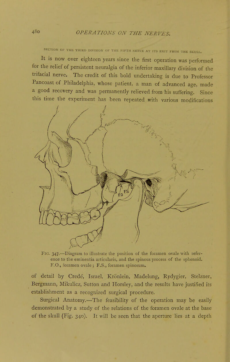 SECTION OF THE THIRD DIVISION OF THE FIFTH NEUVE AT ITS EXIT FROM THE SKULL. It is now over eighteen years since the first operation was performed for the relief of persistent neuralgia of the inferior maxillary division of tlie trifacial nerve. The credit of this bold undertaking is due to Professor Pancoast of Philadelphia, whose patient, a man of advanced age, made a good recovery and was permanently relieved from his suffering. Since this time the experiment has been repeated with various modifications Fjg. 347.—Diagram to illustrate the position of the foramen ovale with refer- ence to the eminentia aiticularis, and the spinous process of the sphenoid. F.O., foramen ovale ; F.S., foramen spinosum. of detail by Crede, Israel, Kronlein, Madelung, Rydygier, Stelzner, Bergmann, Mikulicz, Sutton and Horsley, and the results have justified its estabhshment as a recognized surgical procedure. Surgical Anatomy.—The feasibility of the operation may be easily demonstrated by a study of the relations of the foramen ovale at the base of the skull (Fig. 340). It will be seen that the aperture lies at a depth