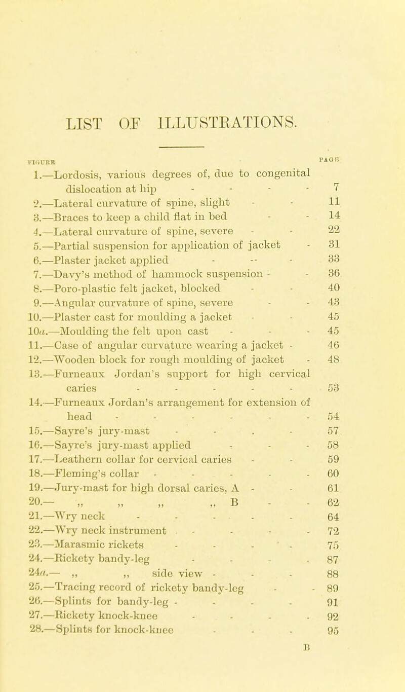 LIST 0.F ILLUSTRATIONS. 1. —Lordosis, various degrees of, due to congenital dislocation at hip . . - - 7 2. —Lateral curvature of spine, slight 11 3. —Braces to keep a child flat in bed - - 14 4. —Lateral curvature of spine, severe - - 22 5. —Partial suspension for application of jacket - 31 6. —Plaster jacket applied - -- - 33 7. —Davy's method of hammock suspension - - 36 8. —Poro-plastic felt jacket, blocked - - 40 9. —Angular curvature of spine, severe - - 43 10. —Plaster cast for moulding a jacket - 45 10a.—Moulding the felt upon cast - - - 45 11. —Case of angular curvature wearing a jacket - 46 12. —Wooden block for rough moulding of jacket - 48 13. —Furneaux Jordan's support for high cervical caries .... 53 14. —Furneaux Jordan's arrangement for extension of head - - - - - - 54 15. —Sayre's jury-mast 57 16. —Sayre's jury-mast applied 7 - - 58 17. —Leathern collar for cervical caries - 59 18. —Fleming's collar - - - - 60 19. —Jury-mast for high dorsal caries, A - 61 20. — „ „ „ B 62 21. —Wry neck - - ... . 64 22. —Wry neck instrument - - - - 72 23. —Marasmic rickets - - ' - 75 24. —Rickety bandy-leg - - - - 87 24«.— „ „ side view 88 25. —Tracing record of rickety bandy-leg - - 89 26. —Splints for bandy-leg 91 27. —Rickety knockdmee - - - - 92 28. —Splints for knock-knee - - - 95 B