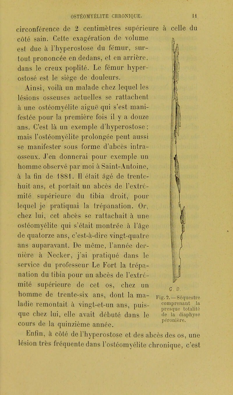 circonférence de 2 centimètres supérieure à celle du côté sain. Celte exagération de volume est due à l'hyperostose du fémur, sur- tout prononcée en dedans, et en arrière, dans le creux poplité. Le fémur hyper- ostosé est le siège de douleurs. Ainsi, voilà un malade chez lequel les lésions osseuses actuelles se rattachent à une ostéomyélite aiguë qui s'est mani- festée pour la première fois il y a douze ans. C'est là un exemple d'hyperostose ; mais l'ostéomyélite prolongée peut aussi se manifester sous forme d'abcès intra- osseux. J'en donnerai pour exemple un homme observé par moi à Saint-Antoine, à la fin de 1881. 11 élait âgé de trente- huit ans, et portait un abcès de l'extré- mité supérieure du tibia droit, pour lequel je pratiquai la trépanation. Or, chez lui, cet abcès se rattachait à une ostéomyélite qui s'était montrée à l'âge de quatorze ans, c'est-à-dire vingt-quatre ans auparavant. De même, l'année der- nière à Necker, j'ai pratiqué dans le service du professeur Le Fort la trépa- nation du tibia pour un abcès de l'extré- mité supérieure de cet os, chez un homme de trente-six ans, dont la ma- ladie remontait à vingt-et-un ans, puis- que chez lui, elle avait débuté dans le cours de la quinzième année. Enfin, à côté de l'hyperostose et des abcès des os, une lésion très fréquente dans l'ostéomyéhte chronique, c'est G. D. Fig. 2. —Séquestre coinprenaut la presque totalité do la diaphysc. péronièrc.