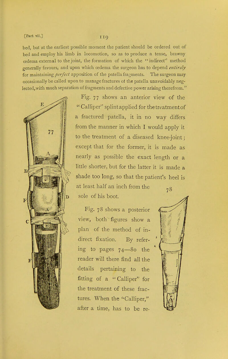 bed, but at the earliest possible momeat the patient should be ordered out of bed and employ his limb iu locomotion, so as to produce a tense, brawny cedema external to the joint, the formation of which the indirect'' method generally favours, and upon which oedema the surgeon has to depend entirely for maintaining/i?r/^ir^ apposition of the patella fragments. The surgeon may occasionally be called upon to manage fractures of the patella unavoidably neg- lected,.with much separation of fragments and defective power arising therefrom. Fig. 77 shows an anterior view of the  Calliper splint applied for the treatment of a fractured patella, it in no way differs from the manner in which I would apply it to the treatment of a diseased knee-joint; except that for the former, it is made as nearly as possible the exact length or a little shorter, but for the latter it is made a shade too long, so that the patient's heel is at least half an inch from the B sole of his boot. 77 Fig. 78 shows a posterior view, both • figures show a plan of the method of in- direct fixation. By refer- ing to pages 74—80 the reader will there find all the details pertaining to the fitting of a Calliper for the treatment of these frac- tures. When the Calliper, after a time, has to be re-