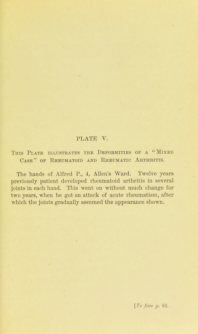 PLATE V. This Plate illustrates the Deformities of a Mixed Case of Rheumatoid and Rheumatic Arthritis. The hands of Alfred P., 4, Allen's Ward. Twelve years previously patient developed rheumatoid arthritis in several joints in each hand. This went on without much change for two years, when he got an attack of acute rheumatism, after which the joints gradually assumed the appearance sho^vn. [To face ]>■ 80.