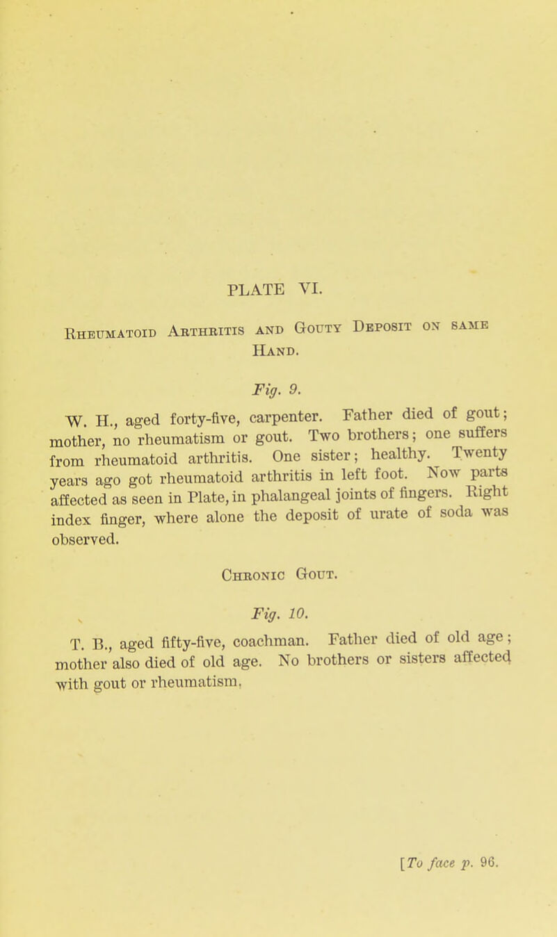Rheumatoid Abthbitis and Gouty Deposit on same Hand. Fig. 9. W H., aged forty-five, carpenter. Father died of gout; mother, io rheumatism or gout. Two brothers; one suffers from rheumatoid arthritis. One sister; healthy. Twenty years ago got rheumatoid arthritis in left foot. Now parts affected as seen in Plate, in phalangeal joints of fingers. Right index finger, where alone the deposit of urate of soda was observed. Chbonic Gout. Fig. 10. T. B., aged fifty-five, coachman. Father died of old age; mother'also died of old age. No brothers or sisters affected with gout or rheumatism, [To face p. 96.