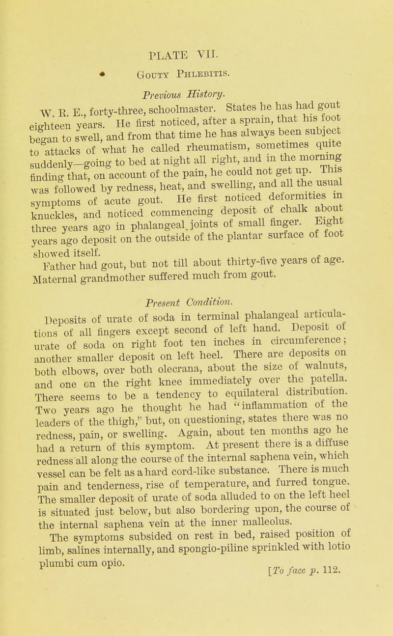 PLATE VII. ♦ Gouty Phlebitis. Previous History. W R E., forty-thi-ee, schoolmaster. States he has had gout eighteen y^ars. He first noticed, after a sprain, that his foo began to swell, and from that time he has always been subject to attacks of what he called rheumatism, sometimes quite suddenly-going to bed at night all right, and - the mornm^^ finding that, on account of the pam, he could not get up. Tins was followed by redness, heat, and swelhng, and all the usual symptoms of acute gout. He first noticed deformities in knuckles, and noticed commencmg deposit of chalk about three years ago in phalangeal, joints of small finger. Eight years ago deposit on the outside of the plantar surface of foot showed itself. Father had gout, but not till about thirty-five years of age. Maternal grandmother suffered much from gout. Present Condition. Deposits of urate of soda in terminal phalangeal articula- tions of all fingers except second of left hand. Deposit of urate of soda on right foot ten inches in circumference; another smaller deposit on left heel. There are deposits on both elbows, over both olecrana, about the size of walnuts, and one on the right laiee immediately over the patella. There seems to be a tendency to equilateral distribution. Two years ago he thought he had inflammation of the leaders of the thigh, but, on questioning, states there was no redness, pain, or swelling. Again, about ten months ago he had a return of this symptom. At present there is a diffuse redness all along the course of the internal saphena vein, which vessel can be felt as a hard cord-like substance. There is much pain and tenderness, rise of temperatm-e, and fni-red tongue. The smaller deposit of urate of soda alluded to on the left heel is situated just below, but also bordering upon, the course of the internal saphena vein at the inner malleolus. The symptoms subsided on rest in bed, raised position of limb, salines internally, and spongio-piline sprinkled with lotio plumbi cum opio. ^ ^ _. ^ . [To face p. 112.