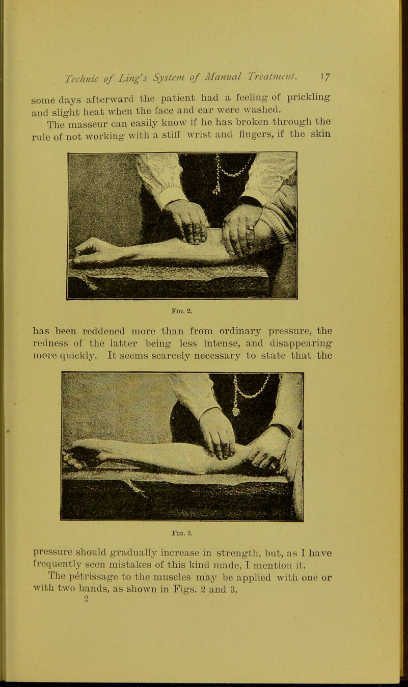 some days afterward the patient had a feehng of prickUng and shg-lit heat when the face and ear were washed. The masseur can easily know if he has broken through the rule of not working- with a stiif wrist and fingers, if the skin Fig. 2. has been reddened more than from ordinary pressure, the redness of the latter being less intense, and disappearing more quickly. It seems scarcely necessary to state that the Fig. 3. pressure should gradually increase in strength, but, as I have frequently seen mistakes of this kind made, I mention it. The petrissage to the muscles may be applied witli one or with two hands, as shown in Figs. 2 and 3. 2