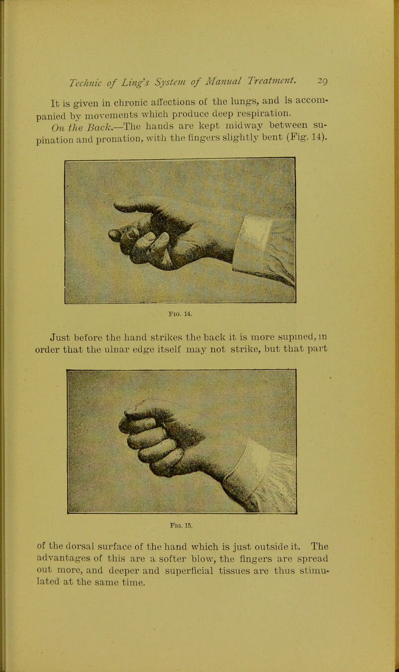 It is given in chronic alTcctions ol the lungs, and is accom- panied by movements which produce deep respiration. On tiie J5acA;.—The hands are kept midway between su- pination and pronation, with the fing-ers shghtly bent (Fig. 14). Fig. 14. Just before the hand stril<es the back it is more supmed, m order that the ulnar edg-e itself may not strike, but that part Fig. 15. of the dorsal surface of the hand which is just outside it. The advantages of this are a softer blow, the fingers are spread out more, and deeper and superficial tissues are thus stimu- lated at the same time.