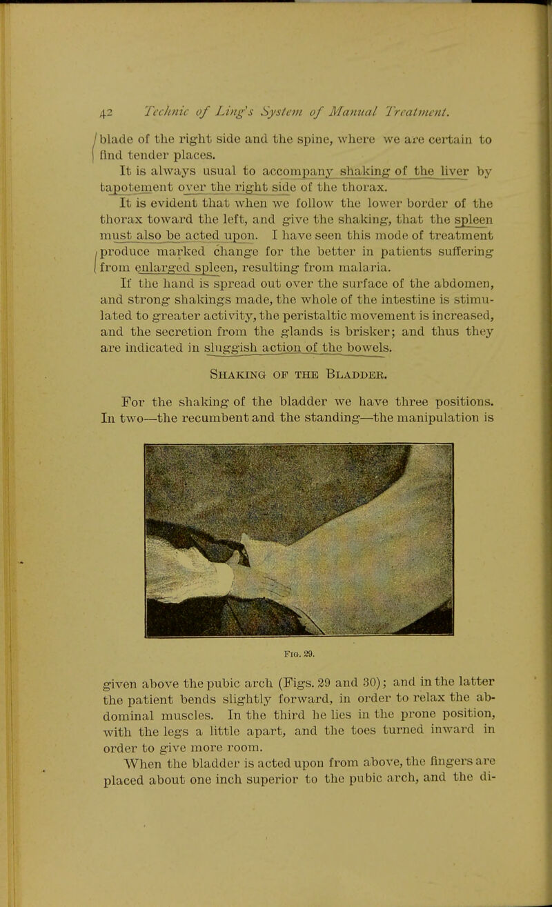 blade of the right side and the spine, where we are certain to find tender places. It is always usual to accompany shaking of the liver by tapotement over the ri^ht side of the thorax. It is evident that when we follow the lower border of the thorax toward the left, and give the shaking, that the spleen must also be acted upon. I have seen this mode of treatment produce marked change for the better in patients suffering from enlarged spleen, resulting from malaria. If the hand is spread out over the surface of the abdomen, and strong shakings made, the whole of the intestine is stimu- lated to greater activity, the peristaltic movement is increased, and the secretion from the glands is brisker; and thus they are indicated in sluggish action_ofjbhe bowels. Shaking of the Bladder. For the shaking of the bladder we have three positions. In two—the recumbent and the standing—the manipulation is Fio. 29. given above the pubic arch (Figs. 29 and 30); and in the latter the patient bends slightly forward, in order to relax the ab- dominal muscles. In the third he lies in the prone position, with the legs a little apart, and the toes turned inward in order to give more room. When the bladder is acted upon from above, the Angers are placed about one inch superior to the pubic arch, and the di-