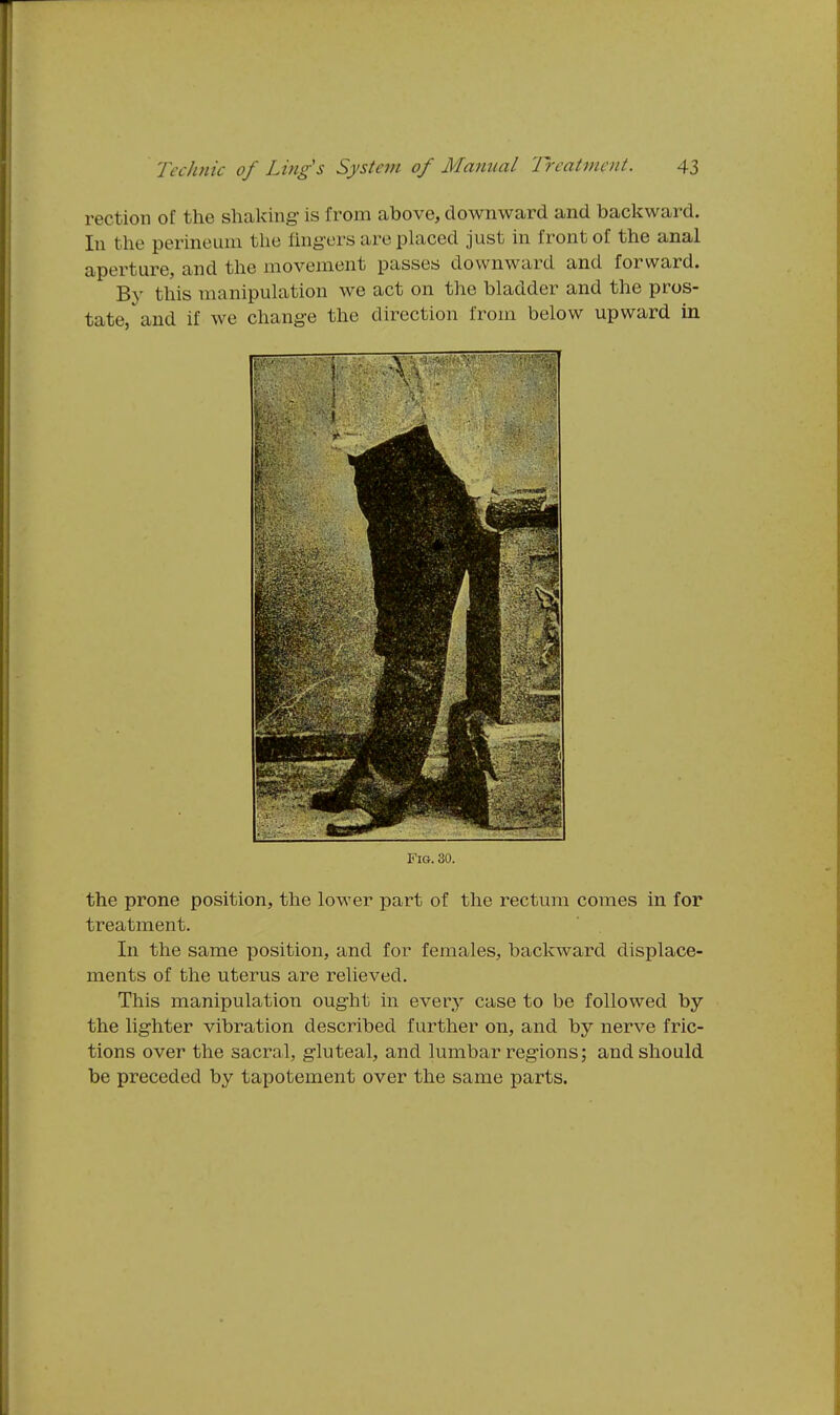 rection of the shaking is from above, downward and backward. In the perineum the fingers are placed just in front of the anal aperture, and the movement passes downward and forward. By this manipulation we act on the bladder and the pros- tate, and if we change the direction from below upward in Fig. 30. the prone position, the lower part of the rectum comes in for treatment. In the same position, and for females, backward displace- ments of the uterus are relieved. This manipulation ought in every case to be followed by the lighter vibration described further on, and by nerve fric- tions over the sacral, gluteal, and lumbar regions; and should be preceded by tapotement over the same parts.