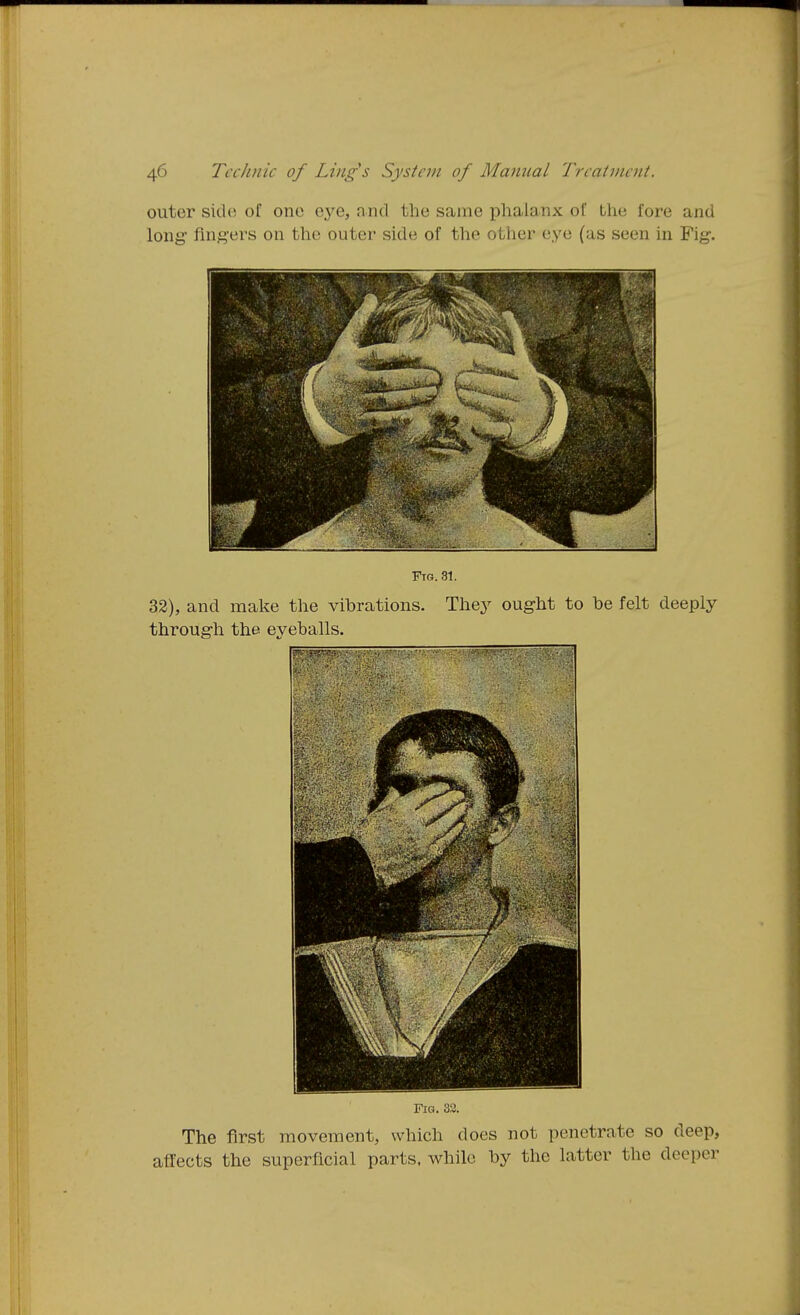 outer side of one ej^e, and the same phalanx of Lhe fore and long' fins'ers on the outer side of the other eye (as seen in Fig. Fig. 31. 32), and malce the vibrations. The3^ ought to be felt deeply through the eyeballs. Fig. 32. The first movement, which does not penetrate so deep, affects the superficial parts, while by the latter the deeper