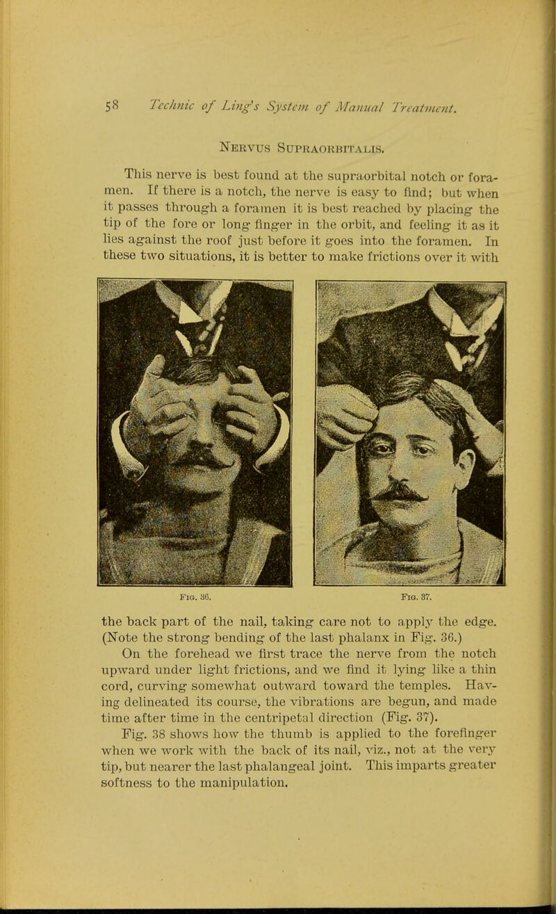 Nervus Supraorbitalis. This nerve is best found at the supraorbital notch or fora- men. If there is a notch, the nerve is easy to find; but when it passes through a foramen it is best reached by placing- the tip of the fore or long- fing-er in the orbit, and feeling- it as it lies against the roof just before it goes into the foramen. In these two situations, it is better to make frictions over it with Fig. 36. Fig. 37. the back part of the nail, taking care not to apply the edge. (Note the strong bending of the last phalanx in Fig. 36.) On the forehead we first trace the nerve from the notch upward under light frictions, and we find it lying like a thin cord, curving somewhat outward toward the temples. Hav- ing delineated its course, the vibrations are begun, and made time after time in the centripet-al direction (Fig. 37). Fig. 38 shows how the thumb is applied to the forefinger when we work with the back of its nail, viz., not at the very tip, but nearer the last phalangeal joint. This imparts greater softness to the manipulation.