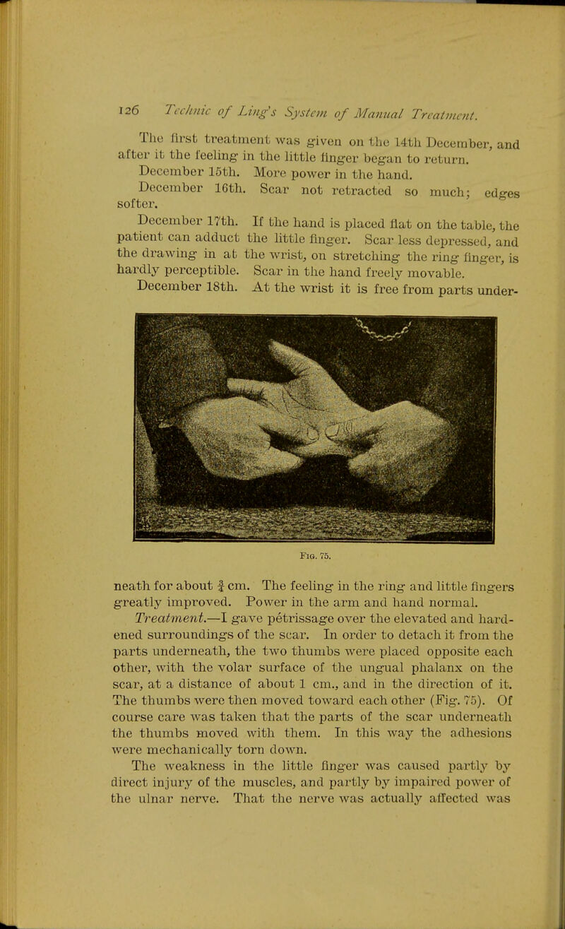 The first treatment was given on tlie 14tli December, and after it tlie feeling- in the little flng-er began to return. December 15th. More power in the hand. December 16th. Scar not retracted so much; edges softer. December 17th. If the hand is placed flat on the table, the patient can adduct the little finger. Scar less depressed, and the drawing in at the wrist, on stretching the ring finger, is hardly perceptible. Scar in the hand freely movable. December 18th. At the wrist it is free from parts under- FlG. 75. neath for about f cm. The feeling in the ring and little fingers greatly improved. Power in the arm and hand normal. Treatment.—I gave petrissage over the elevated and hard- ened surroundings of the sear. In order to detach it from the parts underneath, the two thumbs were placed opposite each other, with the volar surface of the ungual phalanx on the scar, at a distance of about 1 cm., and in the direction of it. The thumbs were then moved toward each other (Fig. 75). Of course care was taken that the parts of the scar underneath the thumbs moved with them. In this way the adhesions were mechanically torn down. The weakness in the little finger was caused partly by direct injury of the muscles, and partly by impaired power of the ulnar nerve. That the nerve was actually affected was