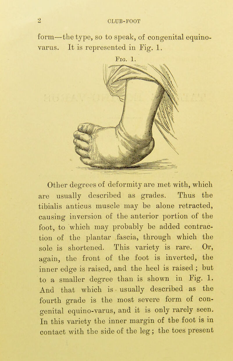 form—the type, so to speak, of congenital equino- varus. It is represented in Fig. 1. Fig. 1. Other degrees of deformity are met with, which are usually described as grades. Thus the tibialis anticus muscle may be alone retracted, causing inversion of the anterior portion of the foot, to which may probably be added contrac- tion of the plantar fascia, through which the sole is shortened. This variety is rare. Or, again, the front of the foot is inverted, the inner edge is raised, and the heel is raised ; but to a smaller degree than is shown in Fig. 1. And that which is usually described as the fourth grade is the most severe form of con- genital equino-varus, and it is only rarely seen. In this variety the inner margin of the foot is in contact with the side of the leg; the toes present