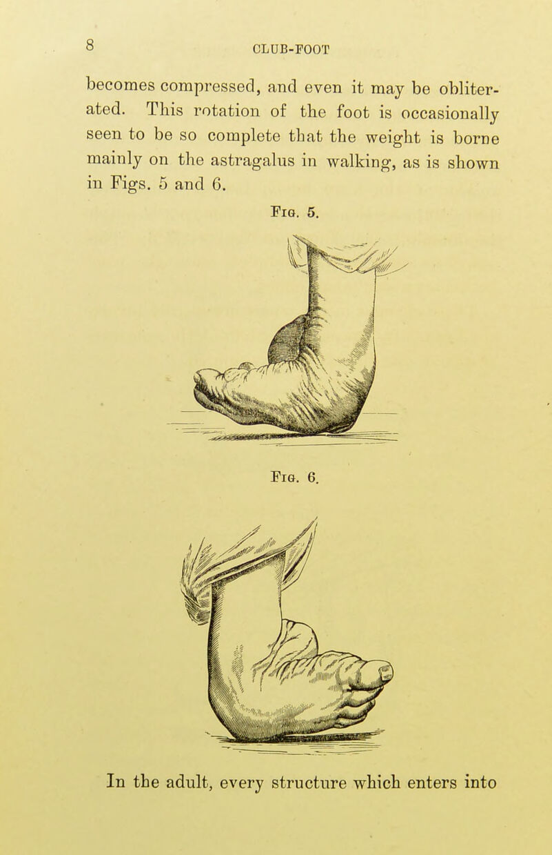 becomes compressed, and even it may be obliter- ated. This rotation of the foot is occasionally seen to be so complete that the weight is borne mainly on the astragalus in walking, as is shown in Figs. 5 and 6. Fig. 5. In the adult, every structure which enters into