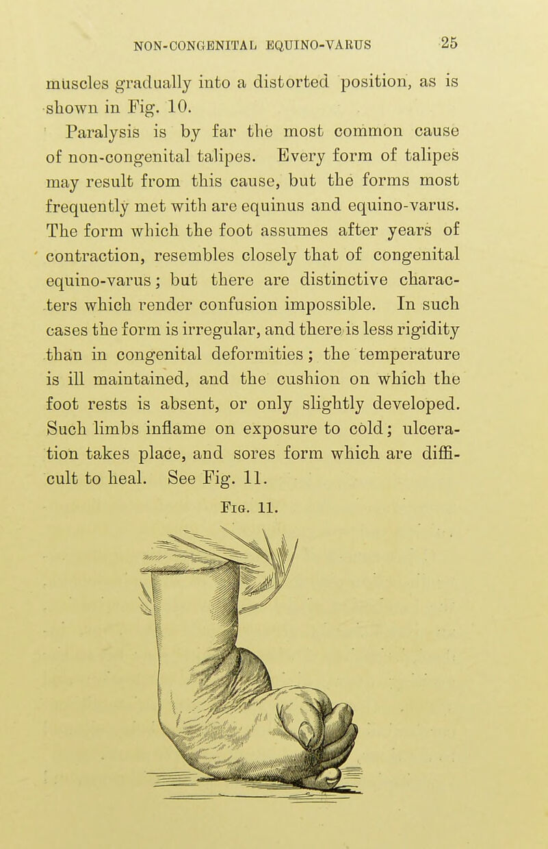 muscles gradually into a distorted position, as is shown in Fig. 10. Paralysis is by far the most common cause of non-congenital talipes. Every form of talipes may result from this cause, but the forms most frequently met with are equinus and equino-varus. The form which the foot assumes after years of contraction, resembles closely that of congenital equino-varus; but there are distinctive charac- ters which render confusion impossible. In such cases the form is irregular, and there is less rigidity than in congenital deformities; the temperature is ill maintained, and the cushion on which the foot rests is absent, or only slightly developed. Such limbs inflame on exposure to cold; ulcera- tion takes place, and sores form which are diffi- cult to heal. See Fig. 11. Fig. 11.