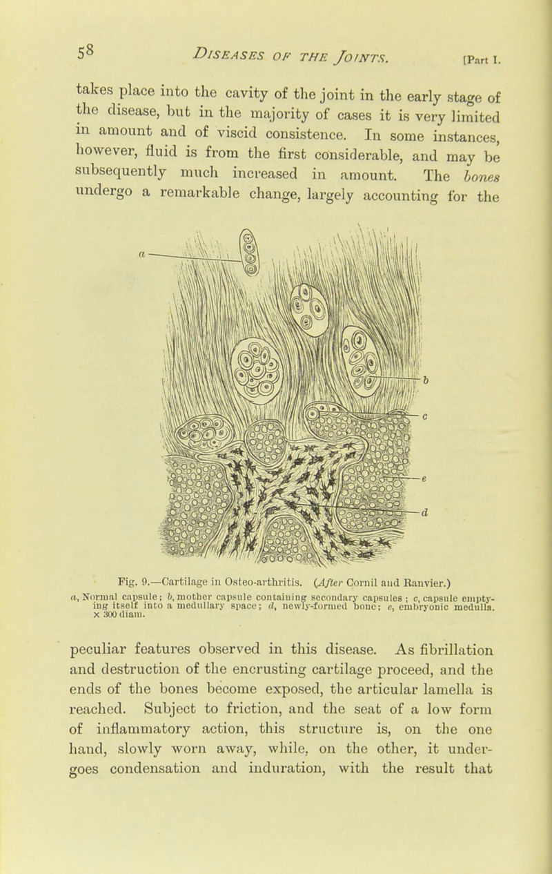 takes place into the cavity of the joint in the early stage of the disease, but in the majority of cases it is very limited in amount and of viscid consistence. In some instances, however, fluid is from the first considerable, and may be subsequently much increased in amount. The bones undergo a remarkable change, largely accounting for the Fig. 9.—Cartilage in Osteoarthritis. {After Comil and Ranvier.) a, Normal capsule; 0, mother capsule containing secondary capsules; c capsule empty- ing itself into a medullary space; </, newly-formed bono; e, embryonic medulla x soo diain. peculiar features observed in this disease. As fibrillation and destruction of the encrusting cartilage proceed, and the ends of the bones become exposed, the articular lamella is reached. Subject to friction, and the seat of a low form of inflammatory action, this structure is, on the one hand, slowly worn away, while, on the other, it under- goes condensation and induration, with the result that