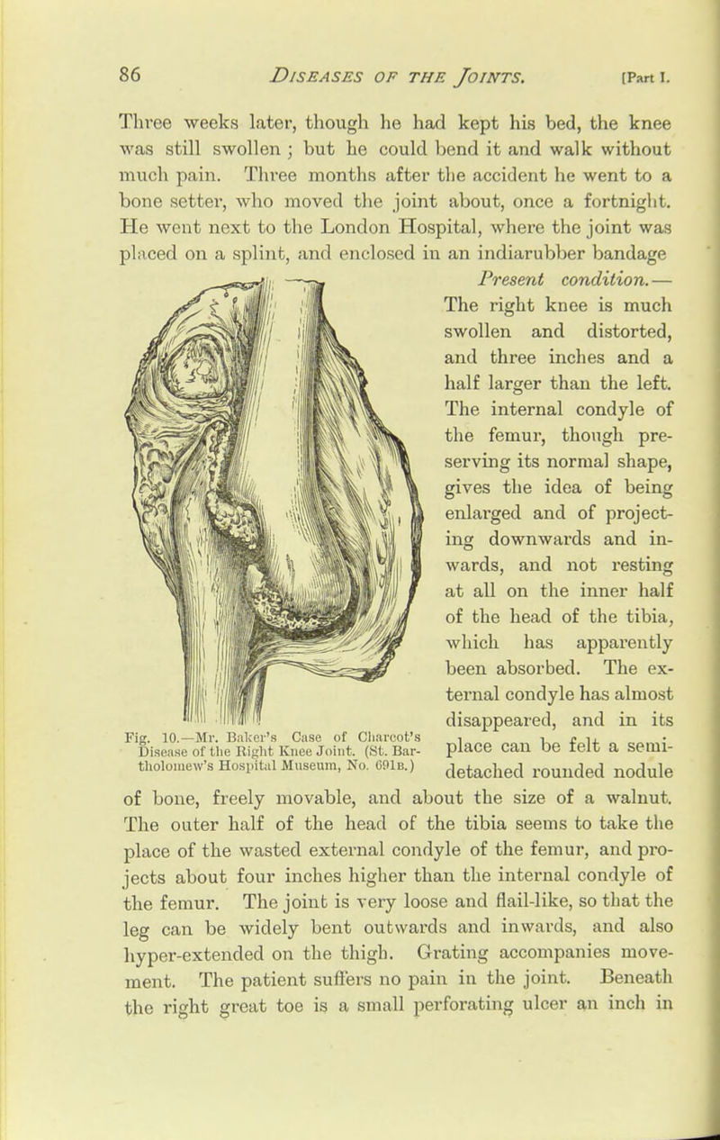 Three weeks later, though he had kept his bed, the knee was still swollen ; but he could bend it and walk without much pain. Three months after the accident he went to a bone setter, who moved the joint about, once a fortnight. He went next to the London Hospital, where the joint was placed on a splint, and enclosed in an indiarubber bandage Present condition. — The right knee is much swollen and distorted, and three inches and a half larger than the left. The internal condyle of the femur, though pre- serving its normal shape, gives the idea of being enlarged and of project- ing downwards and in- wards, and not resting at all on the inner half of the head of the tibia, which has apparently been absorbed. The ex- ternal condyle has almost disappeared, and in its Fig. 10.—Mr. Baker's Case of Charcot's n i c n. Disease of the Right Knee Joint. (St. Bar- place Can be felt a semi- thoiomew'a Hospital Museum, No. 691b.) detached rounded nodule of bone, freely movable, and about the size of a walnut. The outer half of the head of the tibia seems to take the place of the wasted external condyle of the femur, and pro- jects about four inches higher than the internal condyle of the femur. The joint is very loose and flail-like, so that the leg can be widely bent outwards and inwards, and also hyper-extended on the thigh. Grating accompanies move- ment. The patient suffers no pain in the joint. Beneath the right great toe is a small perforating ulcer an inch in