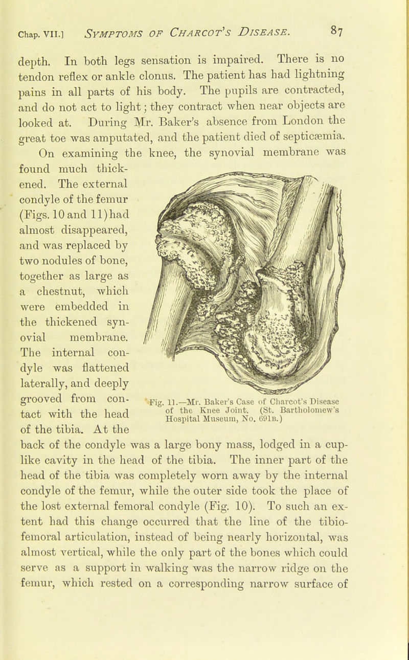 depth. In both legs sensation is impaired. There is no tendon reflex or ankle clonus. The patient has had lightning pains in all parts of his body. The pupils are contracted, and do not act to light; they contract when near objects are looked at. During Mr. Baker's absence from London the great toe was amputated, and the patient died of septicaemia. On examining the knee, the synovial membrane was found much thick- ened. The external condyle of the femur (Figs. 10and ll)had almost disappeared, and was replaced by two nodules of bone, together as large as a chestnut, which were embedded in the thickened syn- ovial membrane. The internal con- dyle was flattened laterally, and deeply grooved from con- tact with the head of the tibia. At the back of the condyle was a large bony mass, lodged in a cup- like cavity in the head of the tibia. The inner part of the head of the tibia was completely worn away by the internal condyle of the femur, while the outer side took the place of the lost external femoral condyle (Fig. 10). To such an ex- tent had this change occurred that the line of the tibio- femoral articulation, instead of being nearly horizontal, was almost vertical, while the only part of the bones which could serve, as a support in walking was the narrow ridge on the femur, which rested on a corresponding narrow surface of ' Fig. 11.—Mr. Baker's Case of Charcot's Disease of the Knee Joint. (St. Bartholomew's Hospital Museum, No. (591b.)