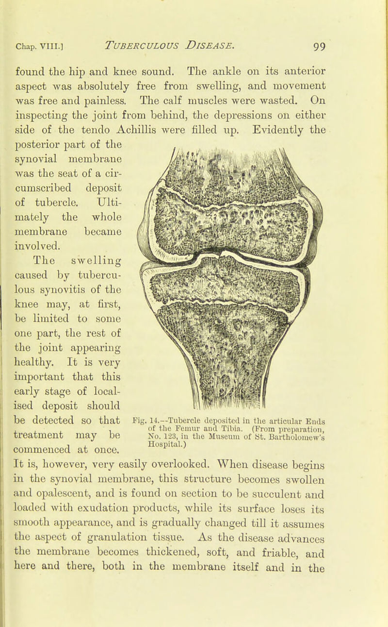 found the hip and knee sound. The ankle on its anterior aspect was absolutely free from swelling, and movement was free and painless. The calf muscles were wasted. On inspecting the joint from behind, the depressions on either side of the tendo Achillis were filled up. Evidently the posterior part of the synovial membrane was the seat of a cir- cumscribed deposit of tubercle. Ulti- mately the whole membrane became involved. The swelling caused by tubercu- lous synovitis of the knee may, at first, be limited to some one part, the rest of the joint appearing healthy. It is very important that this early stage of local- ised deposit should be detected so that treatment may be commenced at once. It is, however, very easily overlooked. When disease begins in the synovial membrane, this structure becomes swollen and opalescent, and is found on section to be succulent and loaded with exudation products, while its surface loses its smooth appearance, and is gradually changed till it assumes the aspect of granulation tissue. As the disease advances the membrane becomes thickened, soft, and friable, and here and there, both in the membrane itself and in the Fig. 14.—Tubercle deposited in the articular Ends (if the Femur and Tibia. (From preparation, No. 123, iu the Museum of St. Bartholomew's Hospital.)