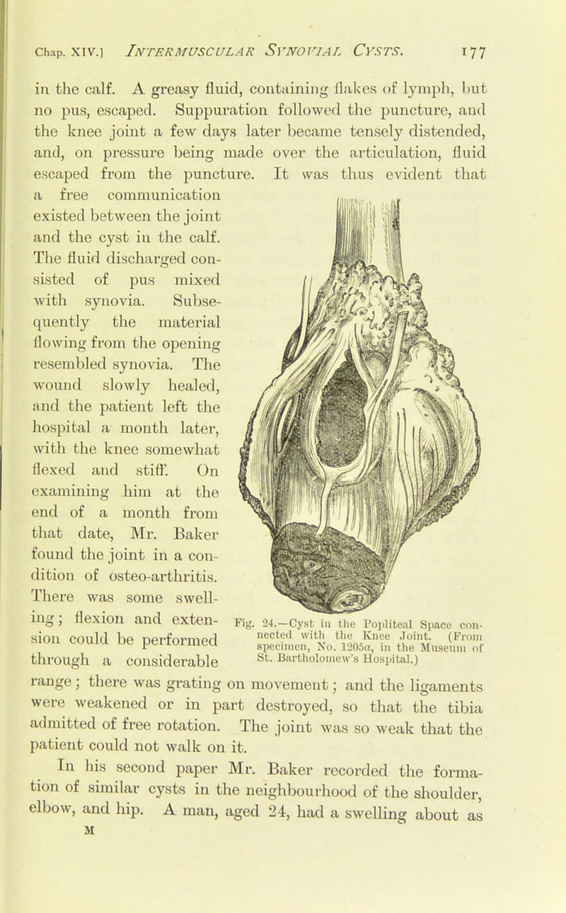 It was thus evident that in the calf. A greasy fluid, containing flakes of lymph, but no pus, escaped. Suppuration followed the puncture, and the knee joint a few days later became tensely distended, and, on pressure being made over the articulation, fluid escaped from the puncture, a free communication existed between the joint and the cyst in the calf. The fluid discharged con- sisted of pus mixed with synovia. Subse- quently the material flowing from the opening resembled synovia. The wound slowly healed, and the patient left the hospital a month later, with the knee somewhat flexed and stiff'. On examining him at the end of a month from that date, Mr. Baker found the joint in a con- dition of osteo-arthritis. There was some swell- ing ; flexion and exten- sion could be performed through a considerable range; there was grating on movement; and the ligaments were weakened or in part destroyed, so that the tibia admitted of free rotation. The joint was so weak that the patient could not walk on it. In his second paper Mr. Baker recorded the forma- tion of similar cysts in the neighbourhood of the shoulder, elbow, and hip. A man, aged 24, had a swelling about as M • 24.—Cyst in the Popliteal Space con- nected with the Knee Joint. (From specimen, No. 1205a, in the Museum of St. Bartholomew's Hospital.)