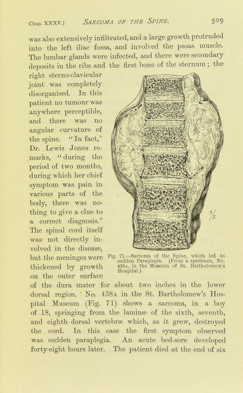 was also extensively infiltrated, and a large growth protruded into the left iliac fossa, and involved the psoas muscle. The lumbar glands were infected, and there were secondary deposits in the ribs and the first bone of the sternum j the right sterno-clavicular joint was completely disorganised. In this patient no tumour was anywhere perceptible, and there was no angular curvature of the spine. In fact, Dr. Lewis Jones re- marks,  during the period of two months, during which her chief symptom was pain in various parts of the body, there was no- thing to give a clue to a correct diagnosis. The spinal cord itself was not directly in- volved in the disease, hut, t,hp mpnino-PQ wprp Fi8- 71.—Sarcoma of the Spine, which led to dul tne meninges were e Paraplegia (From a specimen> No_ thickened bv growth 438a, in the Museum of St. Bartholomew's J ° Hospital.) on the outer surface of the dura mater for about two inches in the lower dorsal region.  No. 438a in the St. Bartholomew's Hos- pital Museum (Fig. 71) shows a sarcoma, in a boy of 18, springing from the laminae of the sixth, seventh, and eighth dorsal vertebrae which, as it grew, destro)'ed the cord. In this case the first symptom observed was sudden paraplegia. An acute bed-sore developed forty-eight hours later. The patient died at the end of six