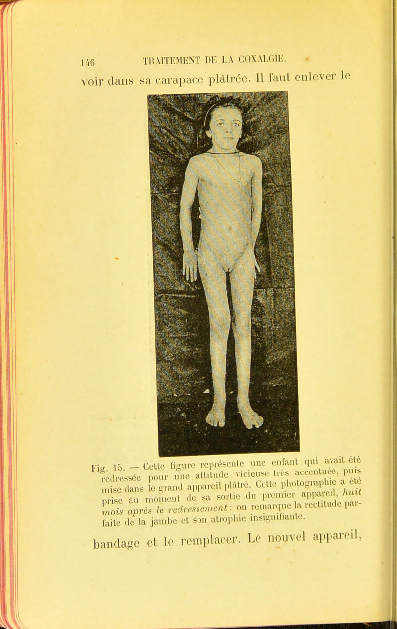 voir clans sa carapace plâtrée. Il faut enlever Fi- 15 - Celte ligure représente une enfant qui avait été redressée pour une altitude vicieuse très accentuée, pu s Sdansfe grand appareil plâtré. Celte V^og^e a W nrise au moment de sa sortie du premier appareil, huit E airfs le redressement: on remarque la rectitude par- faite de la jambe et sou atrophie magnifiante. bandage el le remplacer. Le nouvel appareil,