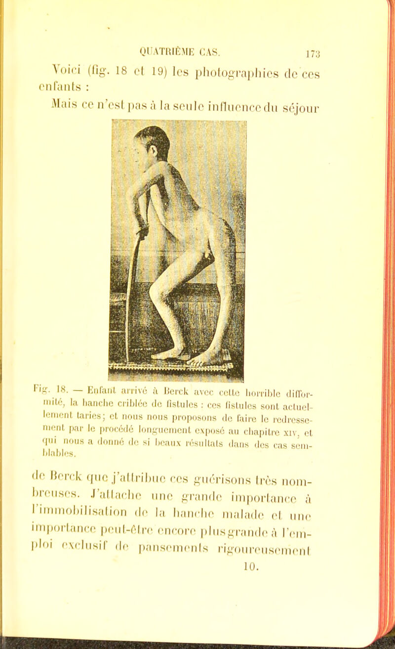 Voici (fig. 18 et 19) les photographies de ces enfants : Mais ce n'est pas à la seule influence du séjour Fig. 18. — Enfant arrivé fi Berck avec cotte horrible diffor- mité, la hanche criblée de fistules : ces fistules sont actuel- lemenl taries; et nous nous proposons de faire le redresse ment par le procédé longuement exposé au chapitre xiv. et qui nous a donné de si beaux résultats dans dos cas sem- blables. de Berck que j'attribue ces guérisons 1res nom- breuses. J'attache une grande importance à l'immobilisation de la hanche malade el une importance peut-être encore plusgrande à l'em- ploi exclusif de pansements rigoureusemenl 10.