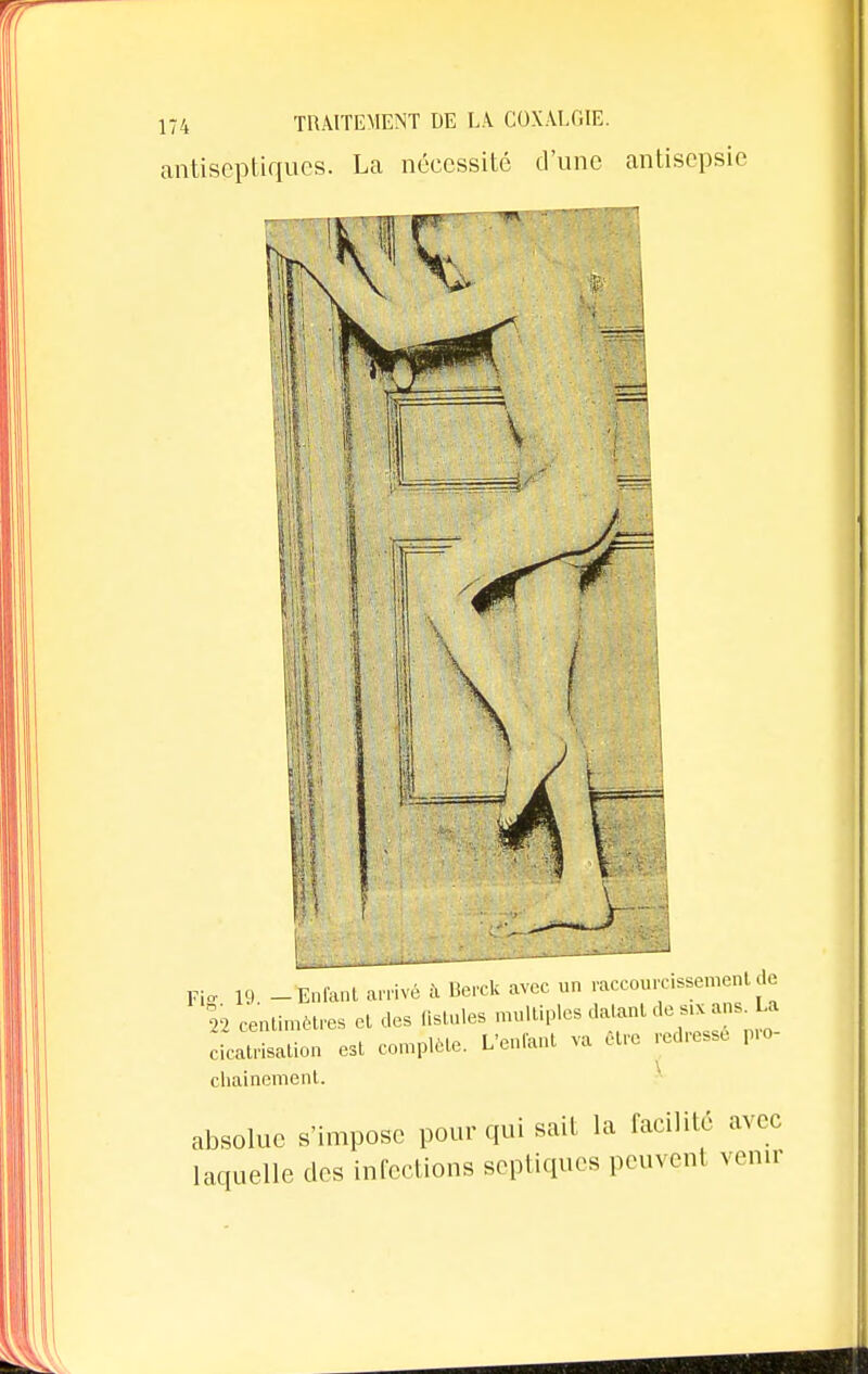 antiseptiques. La nécessité d'une antisepsie Fis 19 --Enfant arrivé à Berck avec un raccourcissement de 22 centimètres et des fistules multiples datant ********* cicatrisation est complète. L'enfant va être redresse pro- chainement. absolue s'impose pour qui sait la facilité avec Laquelle des infections septiques peuvent venir
