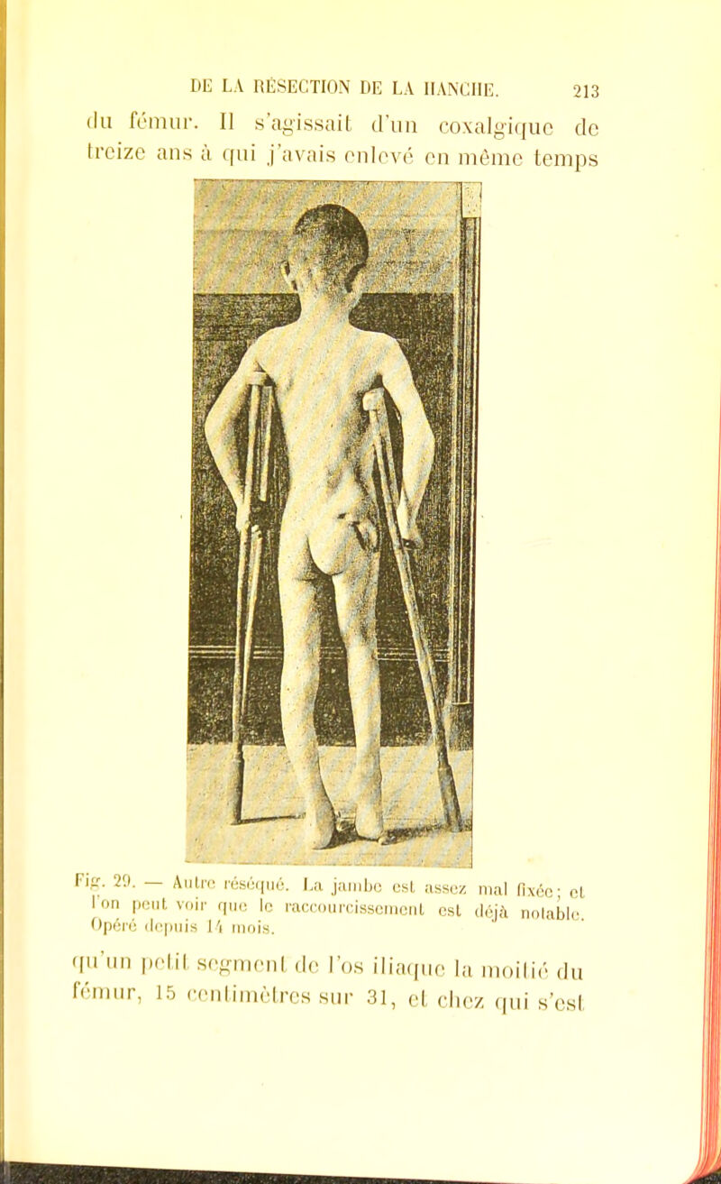 du fémur. Il s'agissait d'un coxalgique de treize ans à qui j'avais enlevé en même temps Fig. 29. — Autre réséqué. La jambe esl assez mal Axée; el 1 n Peut voil que le raccourcissement est déjà notable Opéré depuis I \ mois. '['n petil segmenl de l'os iliaque la moitié du fémur, 15 centimètres sur 31, et chez qui s'est