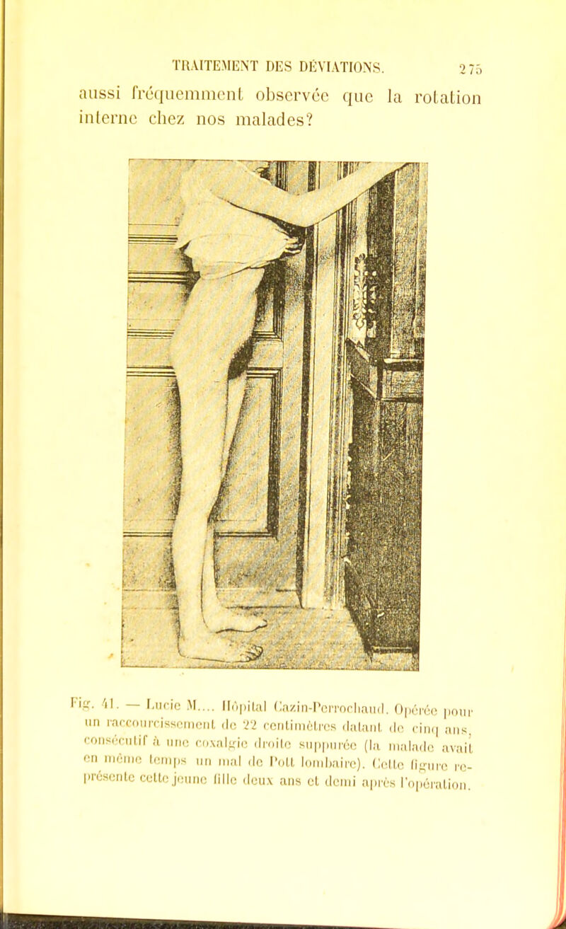 aussi fréquemment observée que la rotation interne chez nos malades? •ig. il. — Lucie M.... Hôpital Cazin-Perrochaud. Opérée pour  raccourcisse ni. de 22 centimètres datant de cinq ans, consécutif è une coxalgie droite suppurée (la malade avaii '• temPs M mal ,1c. Pott lombaire). Celte figure re- présente cette jeune fille deux ans el demi après l'opération