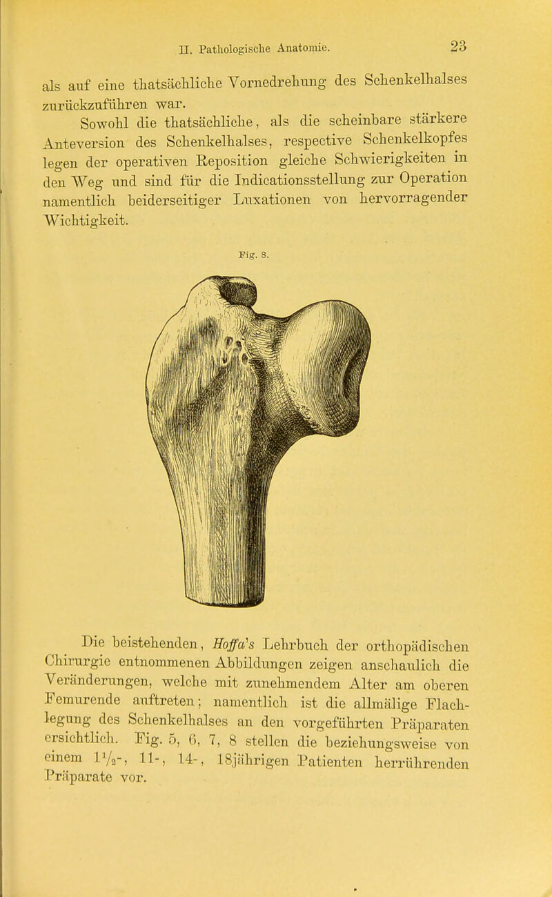 als auf eine thatsächliche Vornedreliung des Schenkelhalses zurückzuführen war. Sowohl die thatsächliche, als die scheinbare stärkere Anteversion des Schenkelhalses, respective Schenkelkopfes legen der operativen Reposition gleiche Schwierigkeiten in den Weg und sind für die Indicationsstellung zur Operation namentlich beiderseitiger Luxationen von hervorragender Wichtigkeit. Fig. 8. Die beistehenden, Hoffa's Lehrbuch der orthopädischen Chirurgie entnommenen Abbildungen zeigen anschaulich die Veränderungen, welche mit zunehmendem Alter am oberen Femurende aiiftreten; namentlich ist die allmälige Flach- legung des Schenkelhalses an den vorgeführten Präparaten ersichtlich. Fig. 5, 6, 7, 8 stellen die beziehungsweise von einem H/,-, 11-, 14-, L8, jährigen Patienten herrührenden Präparate vor.