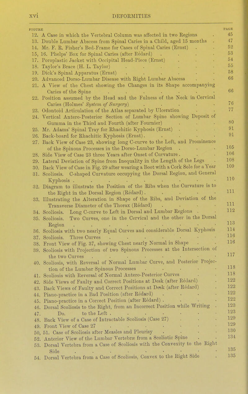 FIGURE PAGE 12. A Case in which the Vertebral Column was affected in two Regions . 45 13. Double Lumbar Abscess from Spinal Caries in a Child, aged 15 months . 17 14. Mr. F. R. Fisher's Bed-Frame for Cases of Spinal Caries (Ernst) . . 52 15. 16. Phelps' Box for Spinal Caries (after Redard) .... 53 17. Poroplastic Jacket with Occipital Head-Piece (Ernst) ... 54 18. Taylor's Brace (H. L. Taylor) ...... 55 19. Dick's Spinal Apparatus (Ernst) ...... 58 20. Advanced Dorso-Lumbar Disease with Right Lumbar Abscess . . 66 21. A View of the Chest showing the Changes in its Shape accompanying Caries of the Spine ....... 66 22. Position assumed by the Head and the Fulness of the Neck in Cervical Caries (Holmes' System of Surgery) . . . ■ ,76 23. Odontoid Articulation of the Atlas separated by Ulceration . . 77 24. Vertical Antero-Posterior Section of Lumbar Spine showing Deposit of Gumma in the Third and Fourth (after Foumier) ... 80 25. Mr. Adams' Spinal Tray for Rhachitic Kyphosis (Ernst) ... 91 26. Back-board for Rhachitic Kyphosis (Ernst). .... 91 27. Back View of Case 23, showing long C-curve to the Left, and Prominence of the Spinous Processes in the Dorso-Lumbar Region . . . 105 28. Side View of Case 23 three Years after Onset of Curvature. . • 106 29. Lateral Deviation of Spine from Inequality in the Length of the Legs . 108 30. Back View of Case in Fig. 29 after wearing a Boot with a Cork Sole for a Year 109 31. Scoliosis. C-shaped Curvature occupying the Dorsal Region, and General Kyphosis ^™ 32. Diagram to illustrate the Position of the Ribs when the Curvature is to the Right in the Dorsal Region (Redard). . . • .111 33. Illustrating the Alteration in Shape of the Ribs, and Deviation of the Transverse Diameter of the Thorax (Redard) .... HI 34. Scoliosis. Long C-curve to Left in Dorsal and Lumbar Regions . 112 35. Scoliosis. Two Curves, one in the Cervical and the other in the Dorsal Region . . . . ■ • • 113 36. Scoliosis with two nearly Equal Curves and considerable Dorsal Kyphosis 114 37. Scoliosis. Three Curves . . • • • . . 116 38. Front View of Fig. 37, showing Chest nearly Normal in Shape . . 116 39. Scoliosis with Projection of two Spinous Processes at the Intersection of the two Curves . . . • • • • 40. Scoliosis, with Reversal of Normal Lumbar Curve, and Posterior Projec- tion of the Lumbar Spinous Processes • 41. Scoliosis with Reversal of Normal Antero-Posterior Curves . 118 42. Side Views of Faulty and Correct Positions at Desk (after Redard) . 122 43. Back Views of Faulty and Correct Positions at Desk (after Redard) . 122 44. Piano-practice in a Bad Position (after Redard) .... 122 45. Piano-practice in a Correct Position (after Redard) .... 122 46. Dorsal Scoliosis to the Right, from an Incorrect Position while Writing . 123 47. Do. to the Left 123 48. Back View of a Case of Intractable Scoliosis (Case 27) . • 129 49. Front View of Case 27 . ■ • • • .129 50. 51. Case of Scoliosis after Measles and Pleurisy . . • .130 52. Anterior View of the Lumbar Vertebra from a Scoliotic Spine . . 134 53. Dorsal Vertebra from a Case of Scoliosis with the Convexity to the Right Side . 54. Dorsal Vertebra from a Case of Scoliosis, Convex to the Right Side . 135 135