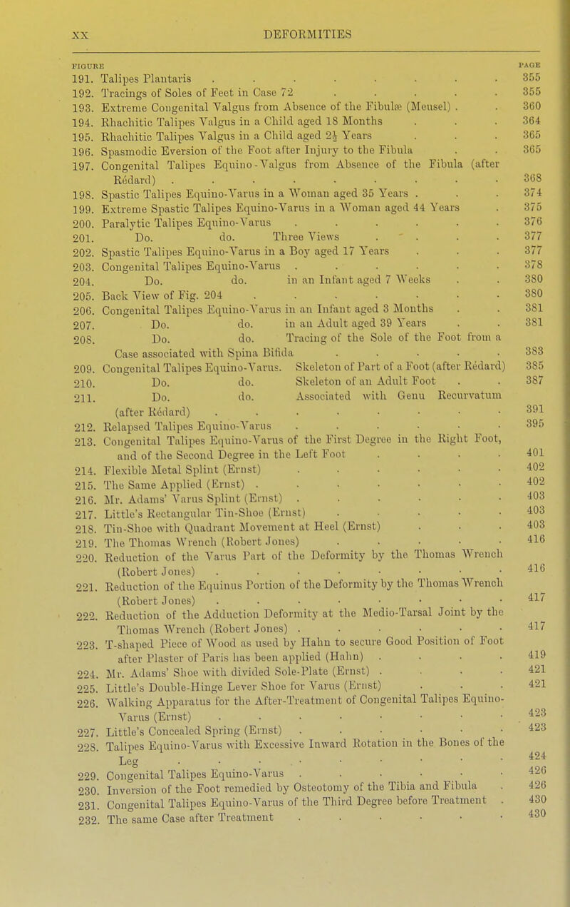 FIGURE 191. Talipes Plantaris ....... 192. Tracings of Soles of Feet in Case 72 .... 193. Extreme Congenital Valgus from Absence of the Fibula; (Meusel) . 194. Ehachitic Talipes Valgus in a Child aged 18 Months 195. Rhachitic Talipes Valgus in a Child aged 2h Years 196. Spasmodic Eversion of the Foot alter Injury to the Fibula 197. Congenital Talipes Equino -Valgus from Absence of the Fibula (after Redard) ........ 198. Spastic Talipes Equino-Varus in a Woman aged 35 Years . 199. Extreme Spastic Talipes Equino-Varus in a Woman aged 44 Years Paralytic Talipes Equino-Varus ..... Do. do. Three Views Spastic Talipes Equino-Varus in a Boy aged 17 Years Congenital Talipes Equino-Ararus ..... Do. do. in an Infant aged 7 Weeks 200. 201. 202. 203. 204. 205. Back View of Fig. 204 206. Congenital Talipes Equino-Varus in an Infant aged 3 Mouths 207. Do. do. in an Adult aged 39 Years 208. Do. do. Tracing of the Sole of the Foot from Case associated with .Spina Bifida Skeleton of Part of a Foot (after Redar Skeleton of an Adult Foot Associated with Genu Recurvatum 209. Congenital Talipes Equino-Varus 210. Do. do. 211. Do. do. (after Redard) 212. Relapsed Talipes Equino-Varus 213. Congenital Talipes Equino-Varus of the First Degree in the Right Foot and of the Second Degree in the Left Foot 214. Flexible Metal Splint (Ernst) 215. The Same Applied (Ernst) .... 216. Mr. Adams' Varus Splint (Ernst) . 217. Little's Rectangular Tin-Shoe (Ernst) 218. Tin-Shoe with Quadrant Movement at Heel (Ernst) 219. The Thomas Wrench (Robert Jones) 220. Reduction of the Varus Part of the Deformity by the Thomas Wrench (Robert Jones) 221. Reduction of the Equinus Portion of the Deformity by the Thomas Wrench (Robert Jones) 222. Reduction of the Adduction Deformity at the Medio-Tarsal Joint by th Thomas Wrench (Robert Jones) ..... 223. T-shaped Piece of Wood as used by Hahu to secure Good Position of Foot after Plaster of Paris has been applied (Halm) . 224. Mr. Adams' Shoe with divided Sole-Plate (Ernst) . 225. Little's Double-Hinge Lever Shoe for Varus (Ernst) 226. Walking Apparatus for the After-Treatment of Congenital Talipes Equine Varus (Ernst) ....... 227. Little's Concealed Spring (Ernst) . . • • ■ 228. Talipes Equino-Varus with Excessive Inward Rotation in the Bones of th Leg 229. Congenital Talipes Equino-Varus . 230. Inversion of the Foot remedied by Osteotomy of the Tibia and Fibula 231. Congenital Talipes Equino-Varus of the Third Degree before Treatment 232. The same Case after Treatment .....