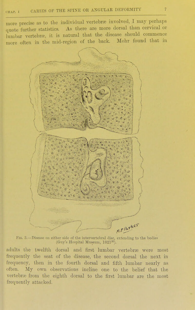 OHAP. I move precise as to the individual vertebrae involved, I may perhaps quote further statistics. As there are more dorsal than cervical or lumbar vertebra, it is natural that the disease should commence more often in the mid-region of the back. Mohr found that in r i 1 Fig. 3.—Disease on either side of the intervertebral disc, extending to the bodies (Guy's Hospital Museum, 102130). adults the twelfth dorsal and first lumbar vertebras were most frequently the seat of the disease, the second dorsal the next in frequency, then in the fourth dorsal and fifth lumbar nearly as often. My own observations incline one to the belief that the vertebra from the eighth dorsal to the first lumbar are the most frequently attacked.