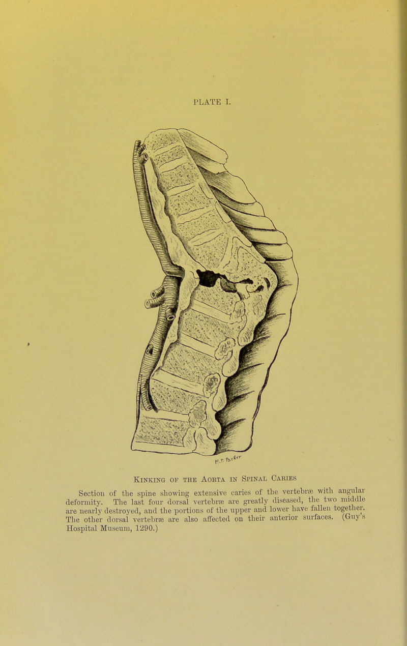 PLATE I. Kinking of the Aorta in Spinal Caries Section of the spine showing extensive caries of the vertebra with anyulai deformity. The last four dorsal vertebra are -really diseased, the. two middle are nearly destroyed, and the portions of the upper and lower have fallen together. The other dorsal vertebra are also affected on their anterior surfaces. (Guys Hospital Museum, 1290.)