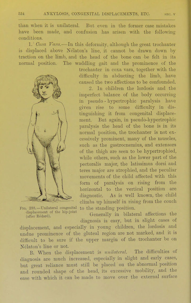 than when it is unilateral. But even in the former ease mistakes have been made, and confusion has arisen with the following conditions. 1. Coxa Vara.—In this deformity, although the great trochanter is displaced above Nelaton's line, it cannot be drawn down by traction on the limb, and the head of the bone can be felt in its normal position. The waddling gait and the prominence of the trochanter in coxa vara, together with the difficulty in abducting the limb, have caused the two affections to be confounded. 2. In children the lordosis and the imperfect balance of the body occurring in pseudo - hypertrophic paralysis have given rise to some difficulty in dis- tinguishing it from congenital displace- ment. But again, in pseudo-hypertrophic paralysis the head of the bone is in its normal position, the trochanter is not ex- cessively prominent, many of the muscles, such as the gastrocnemius, and extensors of the thigh are seen to be hypertrophied, while others, such as the lower part of the pectoralis major, the latissimus dorsi and teres major are atrophied, and the peculiar movements of the child affected with this form of paralysis on rising from the horizontal to the vertical position are diagnostic. As is well known, the child climbs up himself in rising from the couch Fig. 2SS. —Unilateral congenital to the Standing position. '(KrS*!)?' thC hiP'j°int Generally in bilateral affections the diagnosis is easy, but in slight cases of displacement, and especially in young children, the lordosis and undue prominence of the gluteal region are not marked, and it is difficult to be sure if the upper margin of the trochanter be on Nelaton's line or not. B. When the displacement is unilateral. The difficulties of diagnosis are much increased, especially in slight and early cases, but great reliance must still be placed on the abnormal position and rounded shape of the head, its excessive mobility, and the ease with which it can be made to move over the external surface