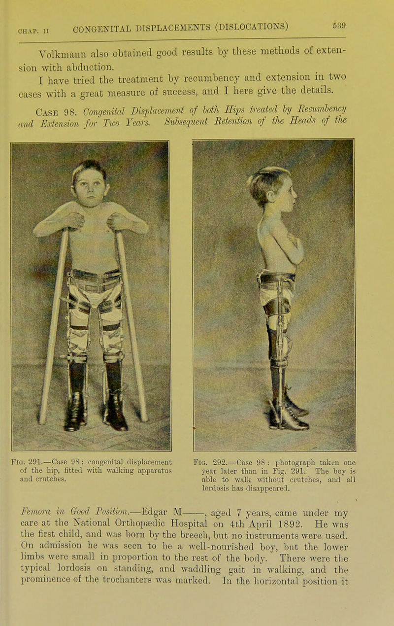 Volkmann also obtained good results by these methods of exten- sion with abduction. I have tried the treatment by recumbency and extension in two cases with a great measure of success, and I here give the details. Case 98. Congenital Displacement of both Hips treated by Recumbency and Extension for Tiro Years. Subsequent Retention of the Heads of the Fig. 291.—Case 98 : congenital displacement Fig. 292.—Case 98 : photograph taken one of the hip, fitted with walking apparatus year later than in Fig. 291. The boy is and crutches. able to walk without crutches, and all lordosis has disappeared. Femora in (loud Position.—Edgar M , aged 7 years, came under my care at the National Orthopedic Hospital on 4th April 1892. He was the first child, and was born by the breech, but no instruments were used, on admission he was seen to be a well-nourished boy, but the lower limbs were small in proportion to the rest of the body. There Avere the typical lordosis on standing, and waddling gait in walking, and the prominence of the trochanters was marked. In the horizontal position it