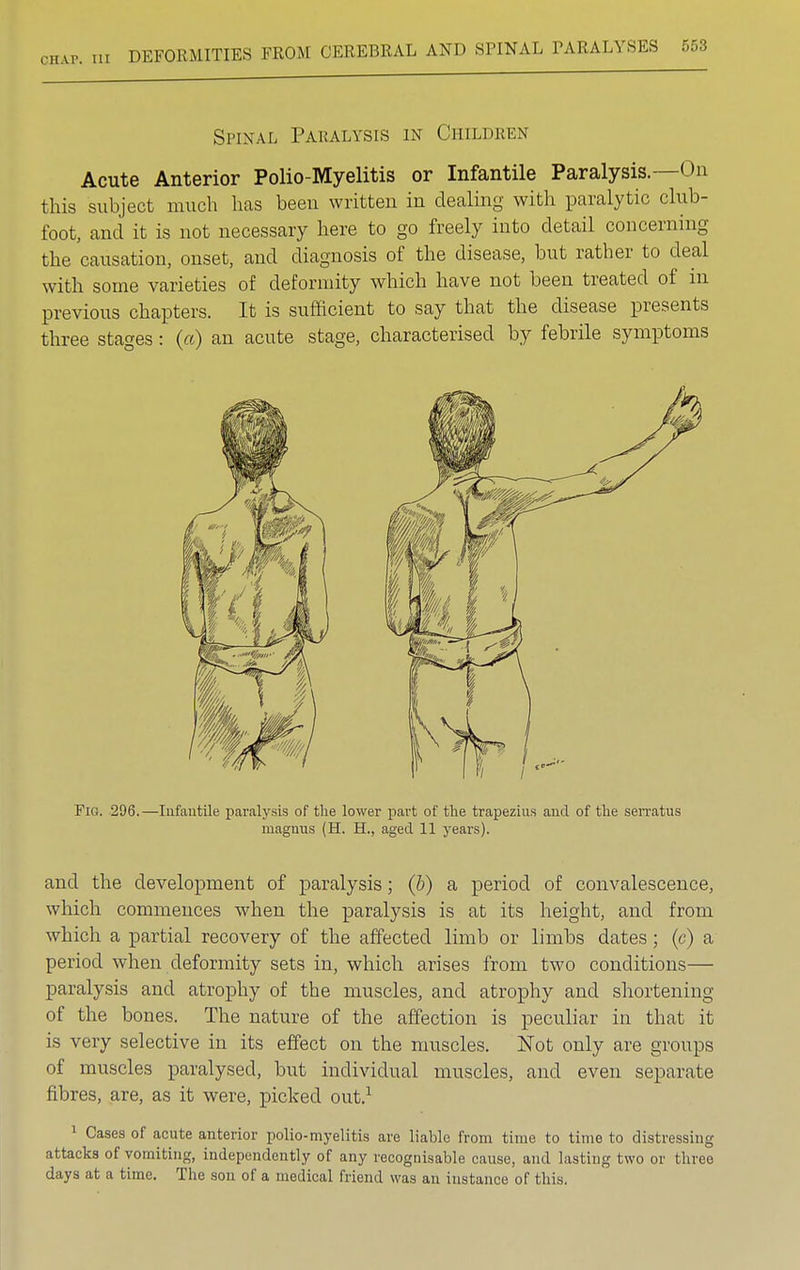 Spinal Paralysis in Children Acute Anterior Polio-Myelitis or Infantile Paralysis.—On this subject much has been written in dealing with paralytic club- foot, and it is not necessary here to go freely into detail concerning the causation, onset, and diagnosis of the disease, but rather to deal with some varieties of deformity which have not been treated of in previous chapters. It is sufficient to say that the disease presents three stages: (a) an acute stage, characterised by febrile symptoms Fig. 296.—Infantile paralysis of the lower part of the trapezius and of the serratus magnus (H. H., aged 11 years). and the development of paralysis; (b) a period of convalescence, which commences when the paralysis is at its height, and from which a partial recovery of the affected limb or limbs dates ; (c) a period when deformity sets in, which arises from two conditions— paralysis and atrophy of the muscles, and atrophy and shortening of the bones. The nature of the affection is peculiar in that it is very selective in its effect on the muscles. Not only are groups of muscles paralysed, but individual muscles, and even separate fibres, are, as it were, picked out.1 1 Cases of acute anterior polio-myelitis are liable from time to time to distressing attacks of vomiting, independently of any recognisable cause, and lasting two or three days at a time. The son of a medical friend was an instance of this.