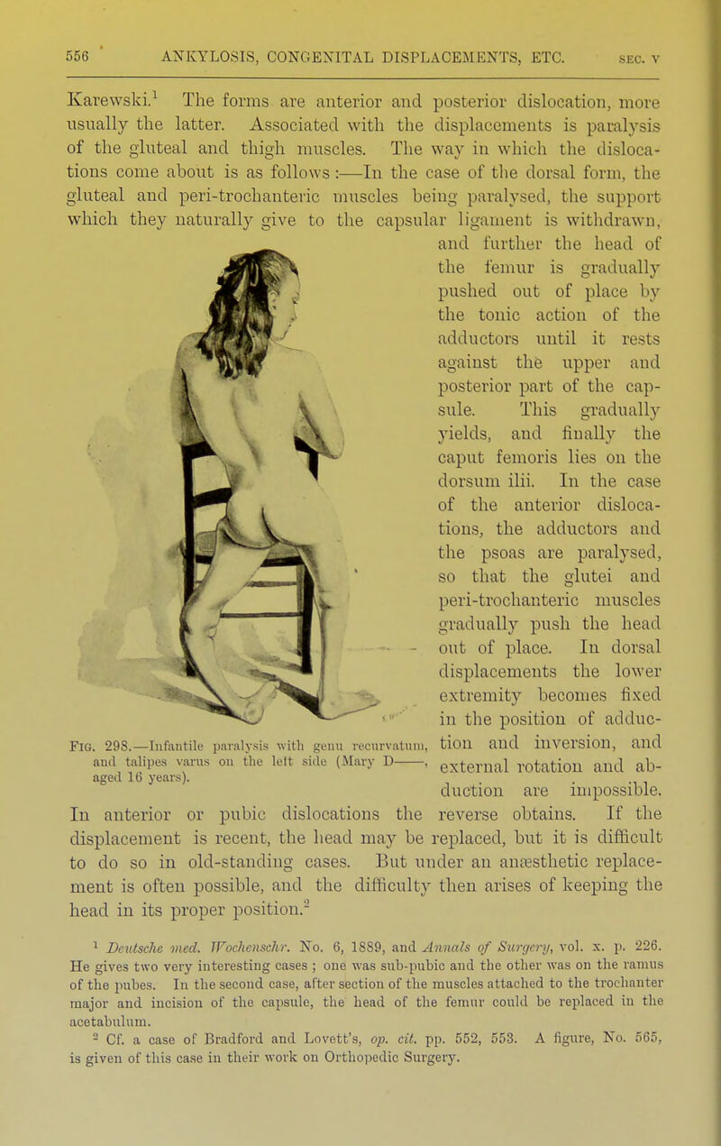 Karewski.1 The forms are anterior and posterior dislocation, more usually the latter. Associated with the displacements is paralysis of the gluteal and thigh muscles. The way in which the disloca- tions come about is as follows :—In the case of the dorsal form, the gluteal and peri-trochanteric muscles being paralysed, the support which they naturally give to the capsular ligament is withdrawn. and further the head of the femur is gradually pushed out of place by the tonic action of the adductors until it rests against the upper and posterior part of the cap- sule. This gradual ly yields, aud fiually the caput femoris lies on the dorsum ilii. In the case of the anterior disloca- tions, the adductors and the psoas are paralysed, so that the glutei and peri-trochanteric muscles gradually push the head - out of place. In dorsal displacements the lower extremity becomes fixed in the position of adduc- FlG. 29S.—Infantile paralysis with genu recurvatum, tioil aud inversion, and and talipes varus on the lelt side (Mary D , external rotation and ab- aged 16 years). • . duction are impossible. In anterior or pubic dislocations the reverse obtains. If the displacement is recent, the head may be replaced, but it is difficult to do so in old-standing cases. But under an anaesthetic replace- ment is often possible, and the difficulty then arises of keeping the head in its proper position.2 1 Deutsche vied. TFochenschr. No. 6, 1889, and Annals of Surgery, vol. x. p. 226. He gives two very interesting cases ; one was snb-pubic and the other was on the ramus of the pubes. In the second case, after section of the muscles attached to the trochanter major and incision of the capsule, the head of the femur could be replaced in the acetabulum. 2 Cf. a case of Bradford and Lovett's, op. cit. pp. 552, 553. A figure, No. 565, is given of this case in their work on Orthopedic Surgery.